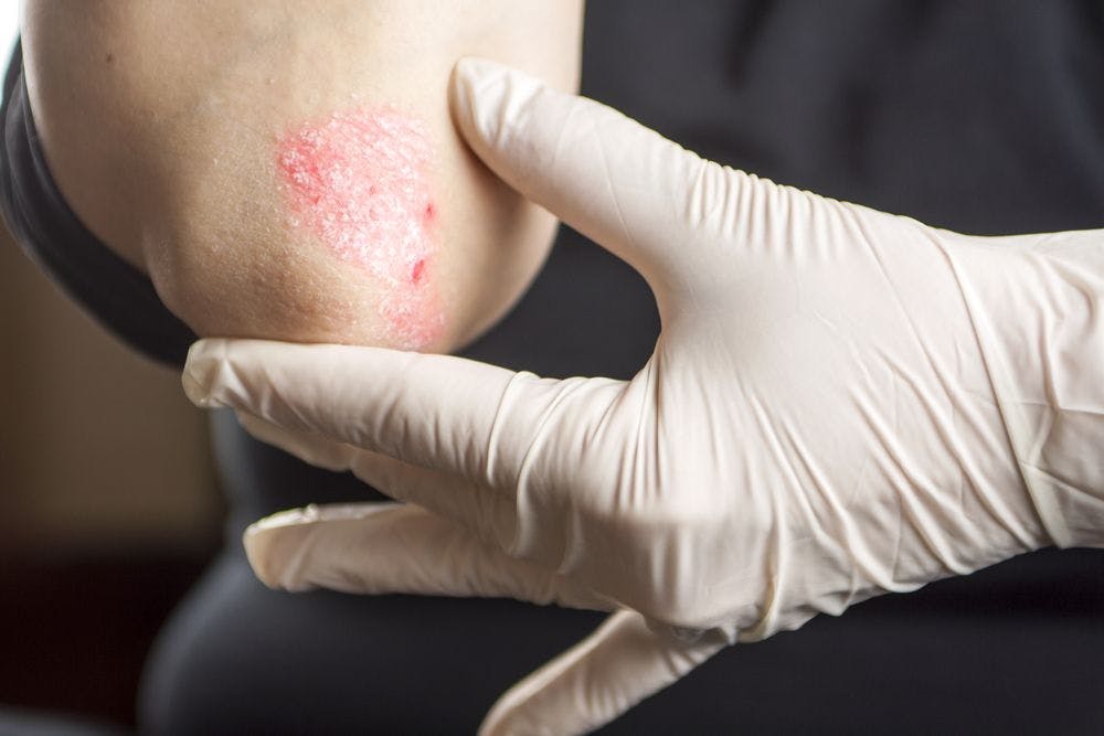 FDA approves plaque psoriasis topical