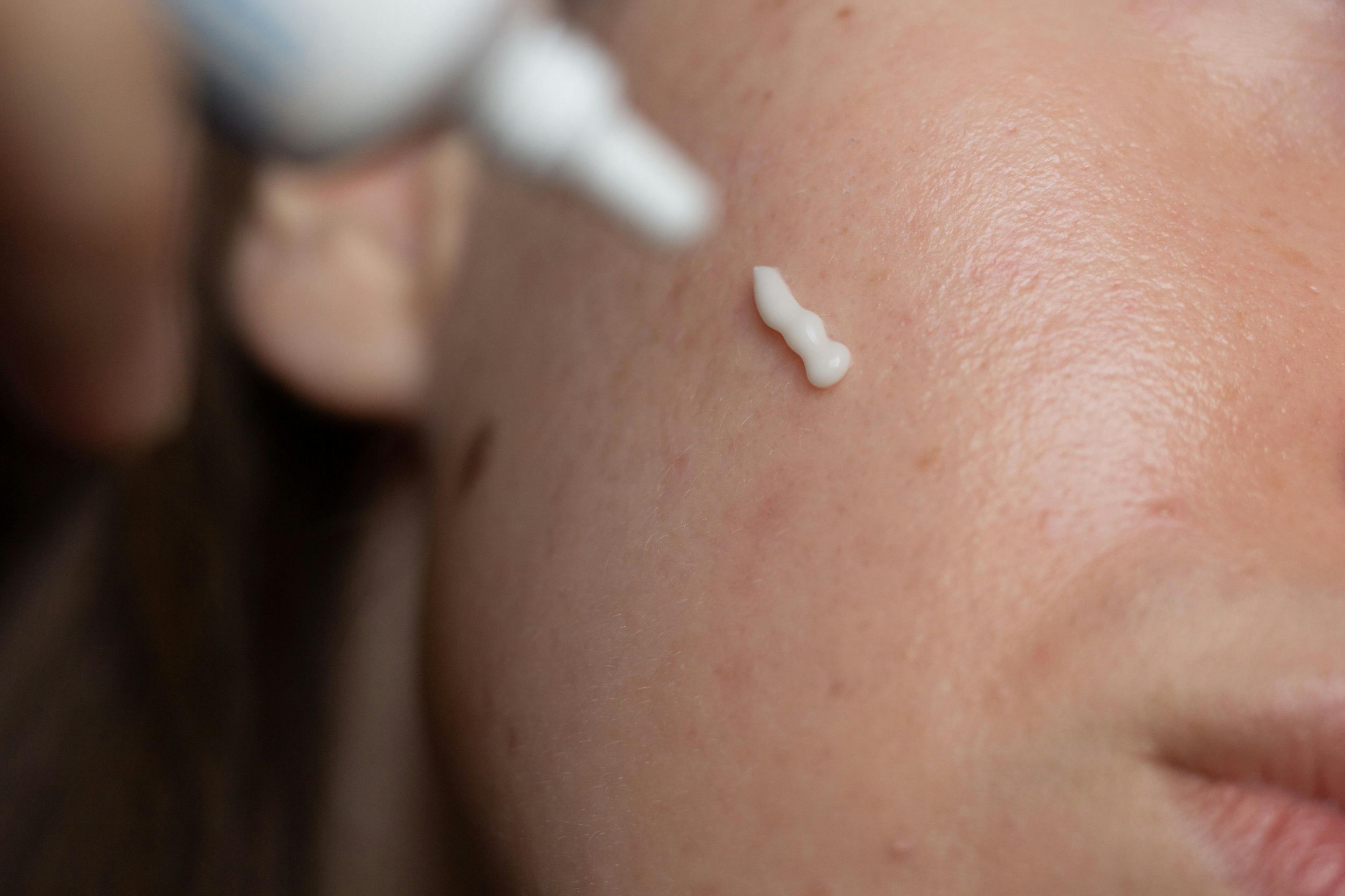 POLL: Have You Heard of the New AAD Acne Guidelines?