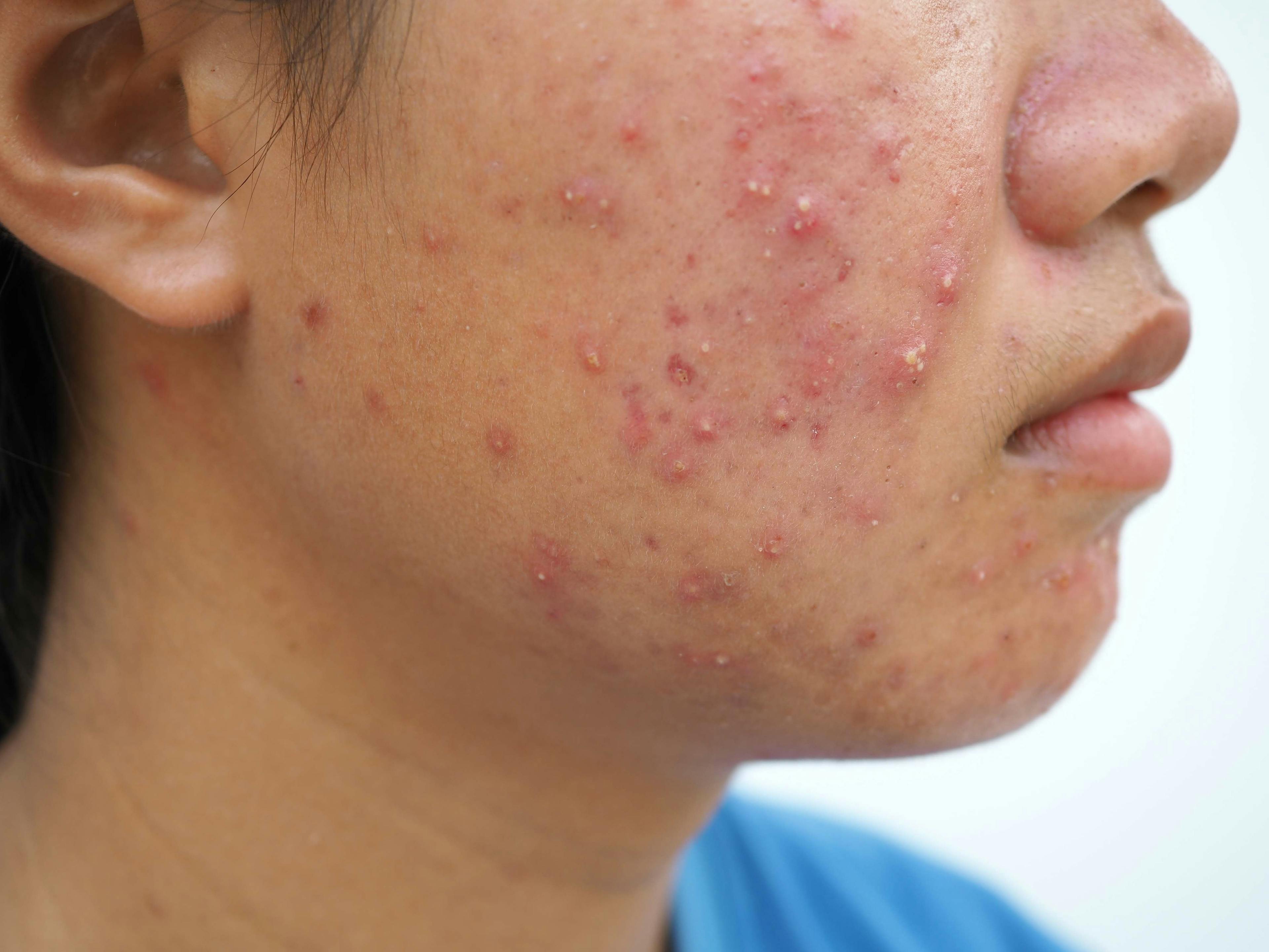 IDP-126 Gel Reduces Inflammatory and Noninflammatory Acne Lesions By 70% 