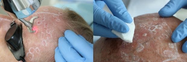 A two-system procedure for clearing actinic keratoses
