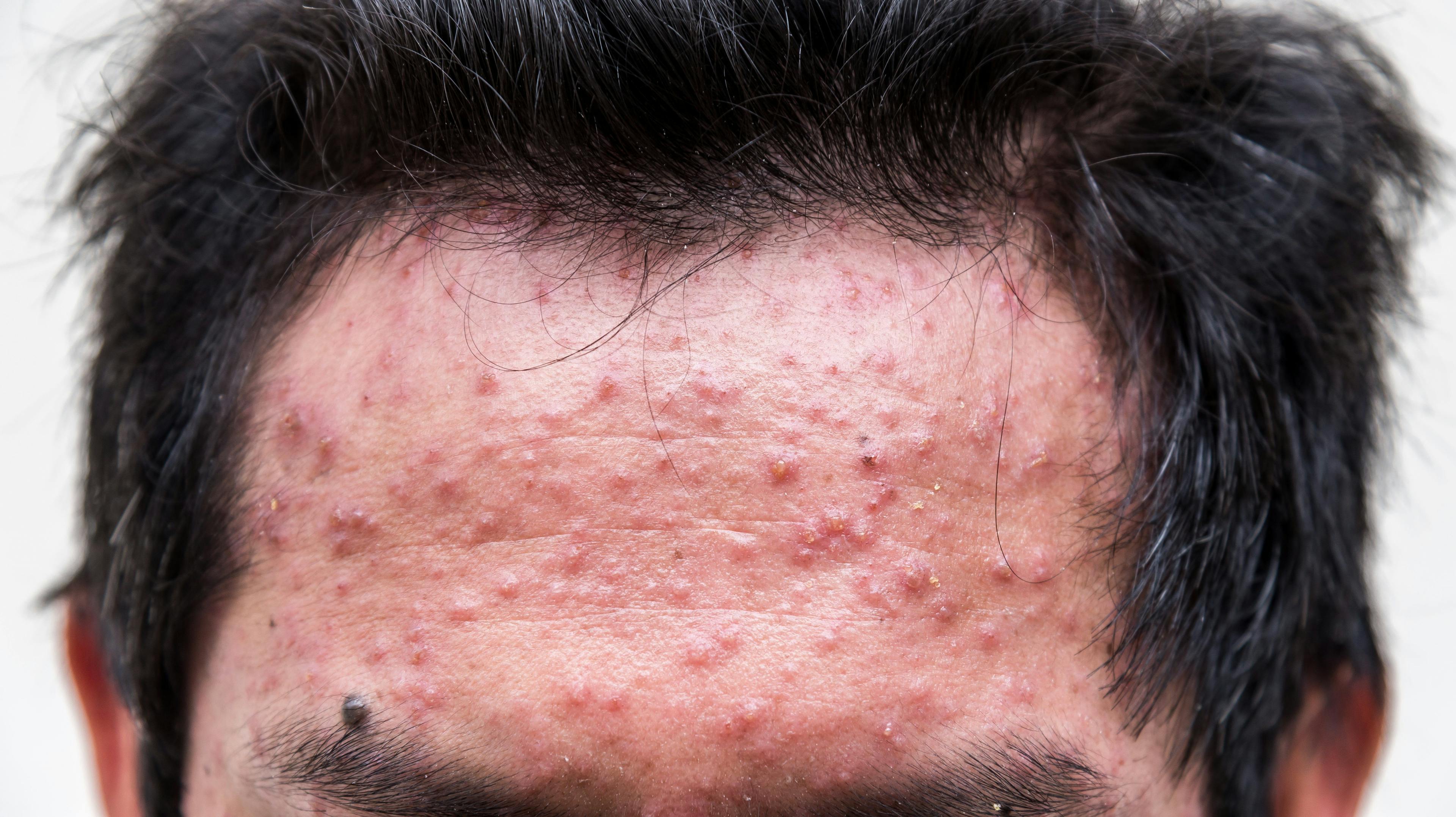 severe acne on forehead