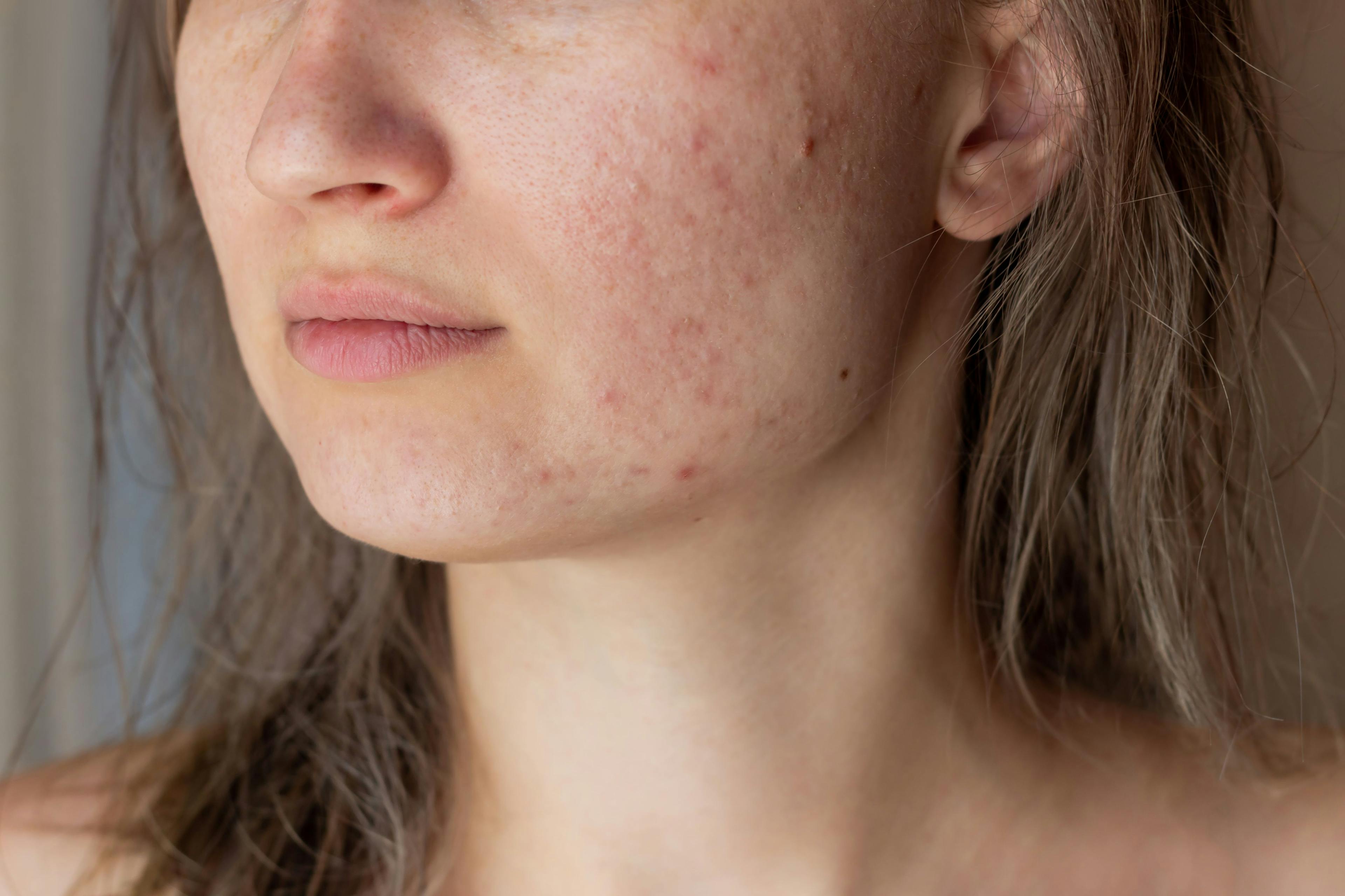 Diet and Acne: What is the Association?