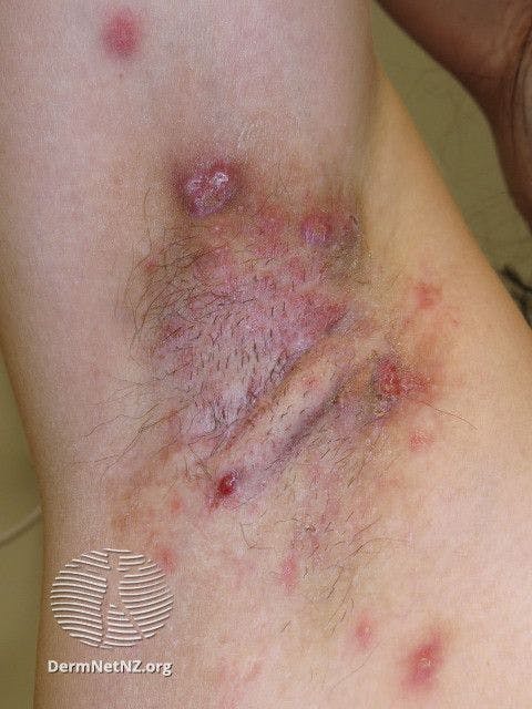 Hidradenitis suppurativa of axilla | Image Credit: https://dermnetnz.org/topics/hidradenitis-suppurativa-images