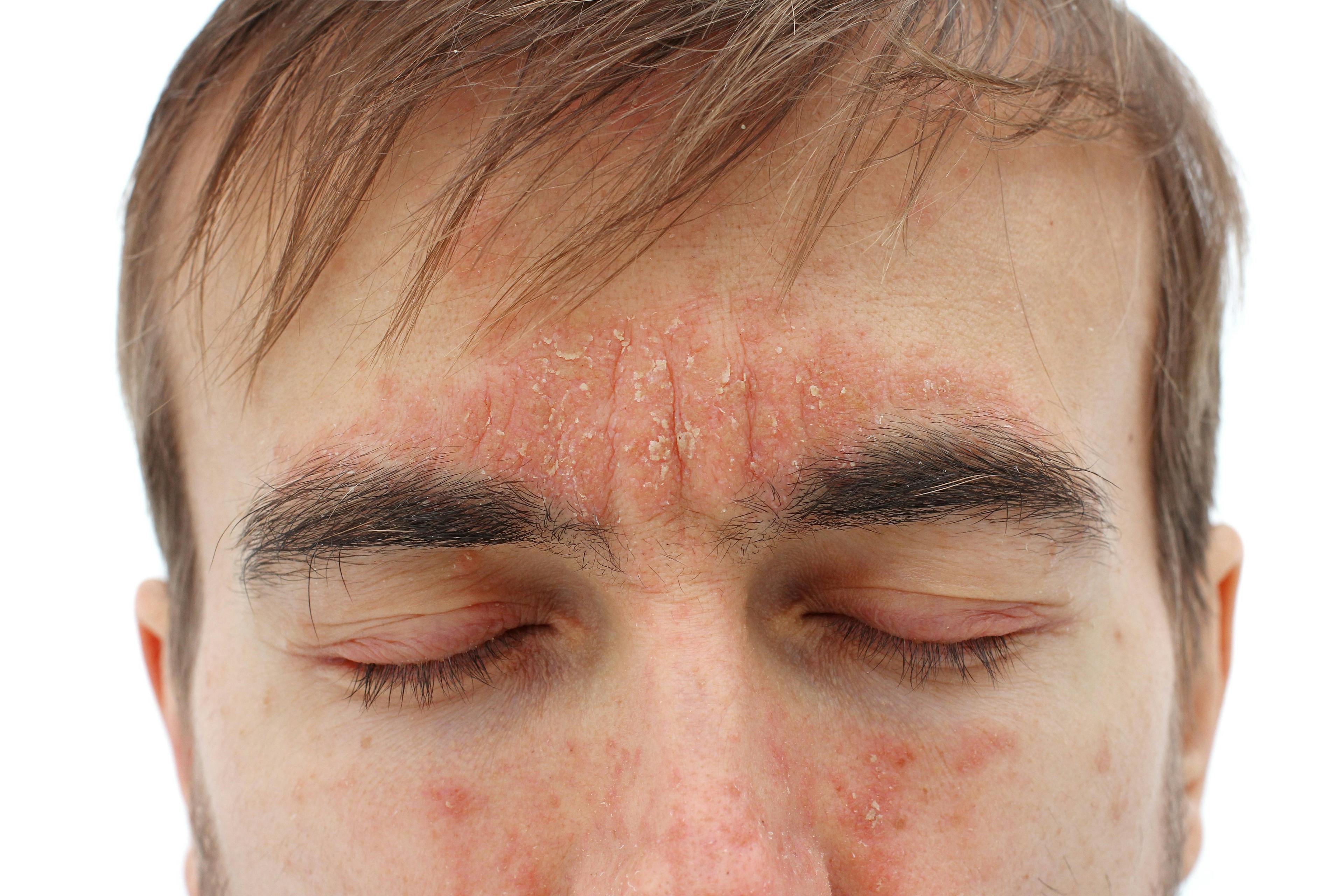 Close up view of man with eyes closed and atopic dermatitis around the forehead and nose