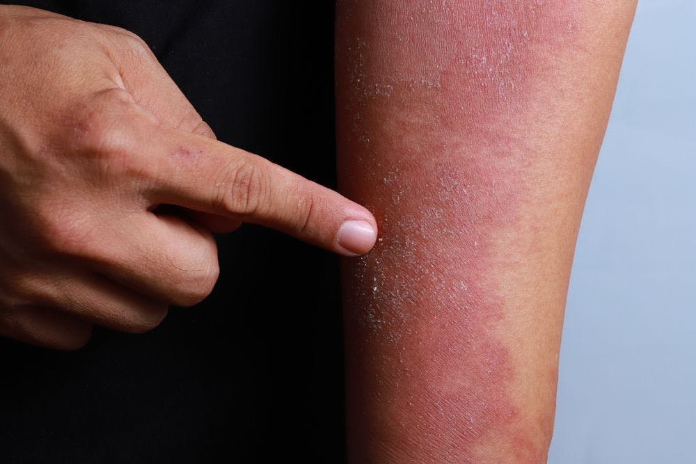 Atopic Dermatitis (©TYLimShutterstock.com