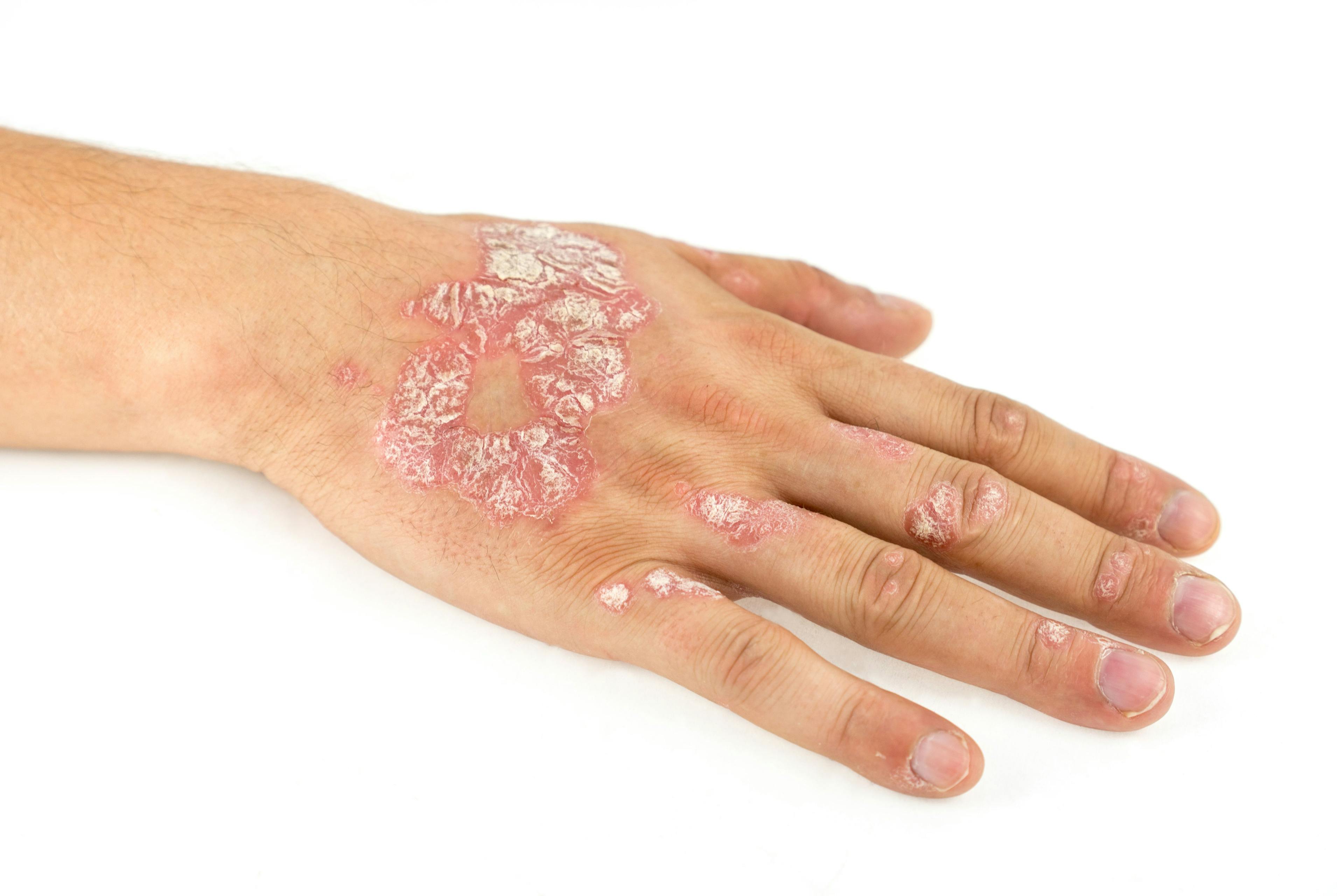Spesolimab Effective in Treating Generalized Pustular Psoriasis Flares