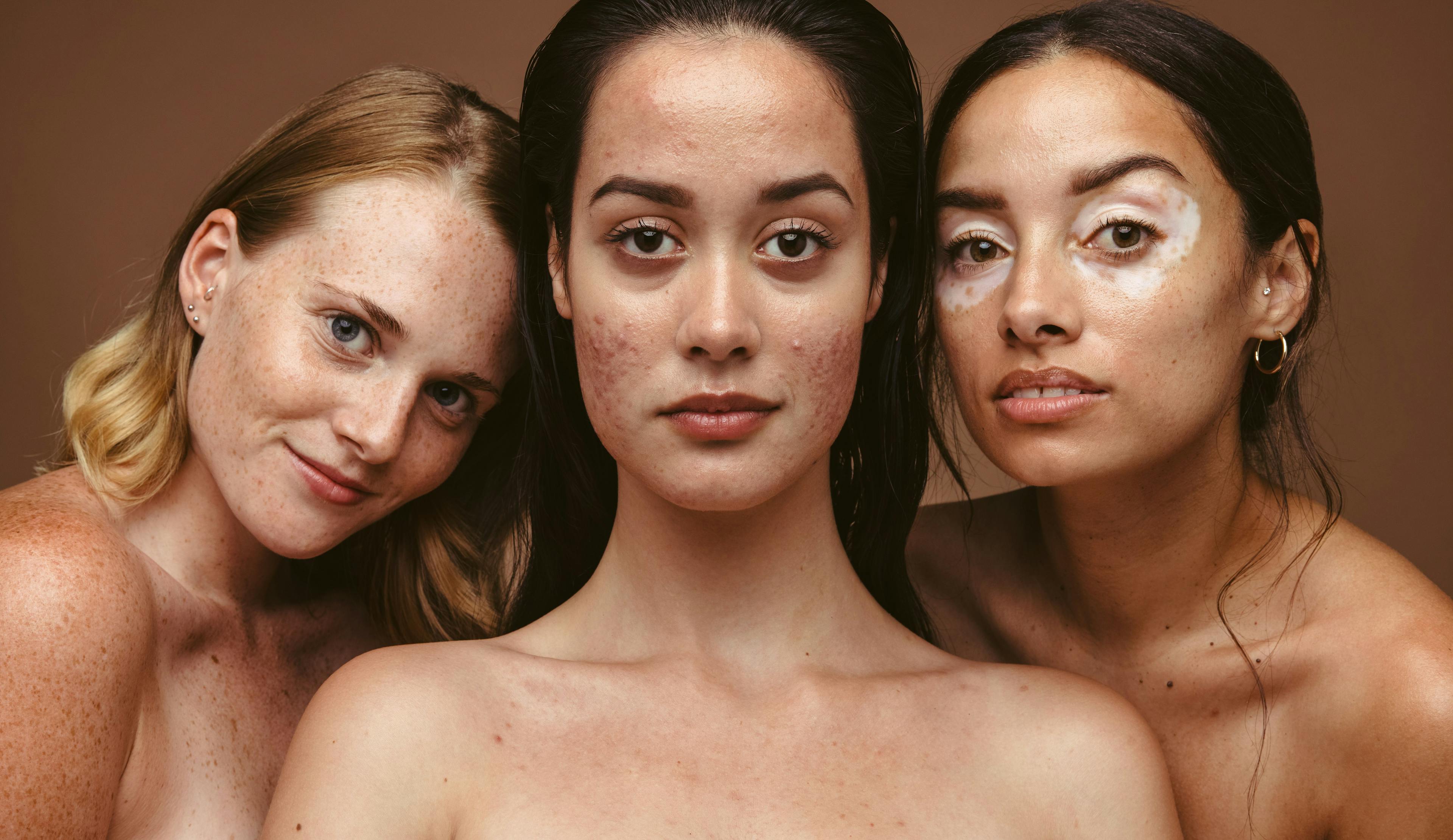 Addressing Skin of Color Disparities in Cosmetic Dermatology