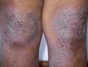 Atopic dermatitis on the knees of an individual with skin of color