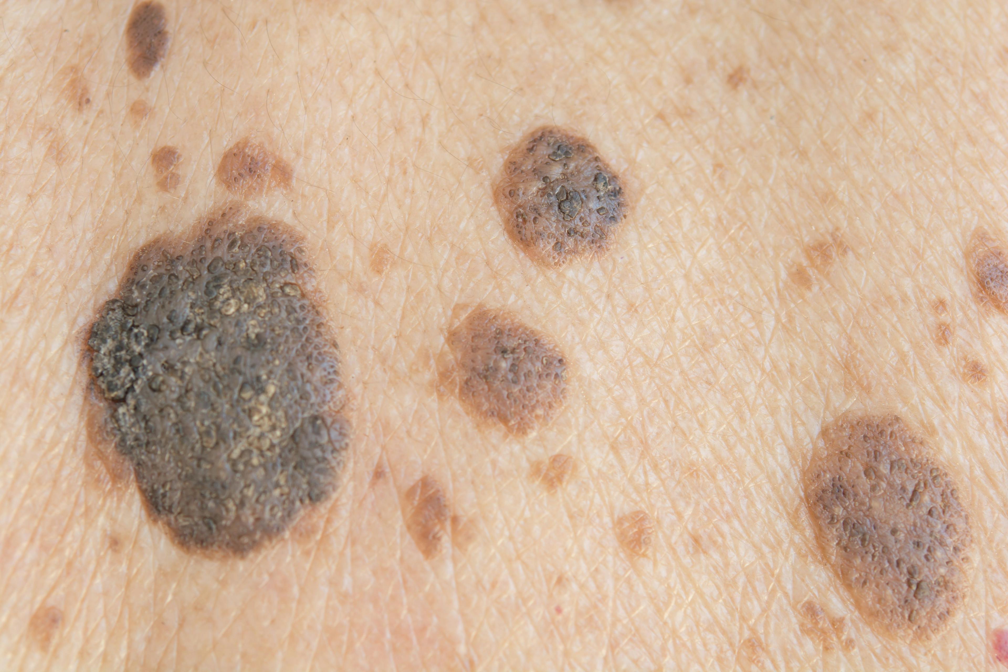 New Imaging System Differentiates Between Melanoma and Nonmelanoma Nevi with 100% Sensitivity 