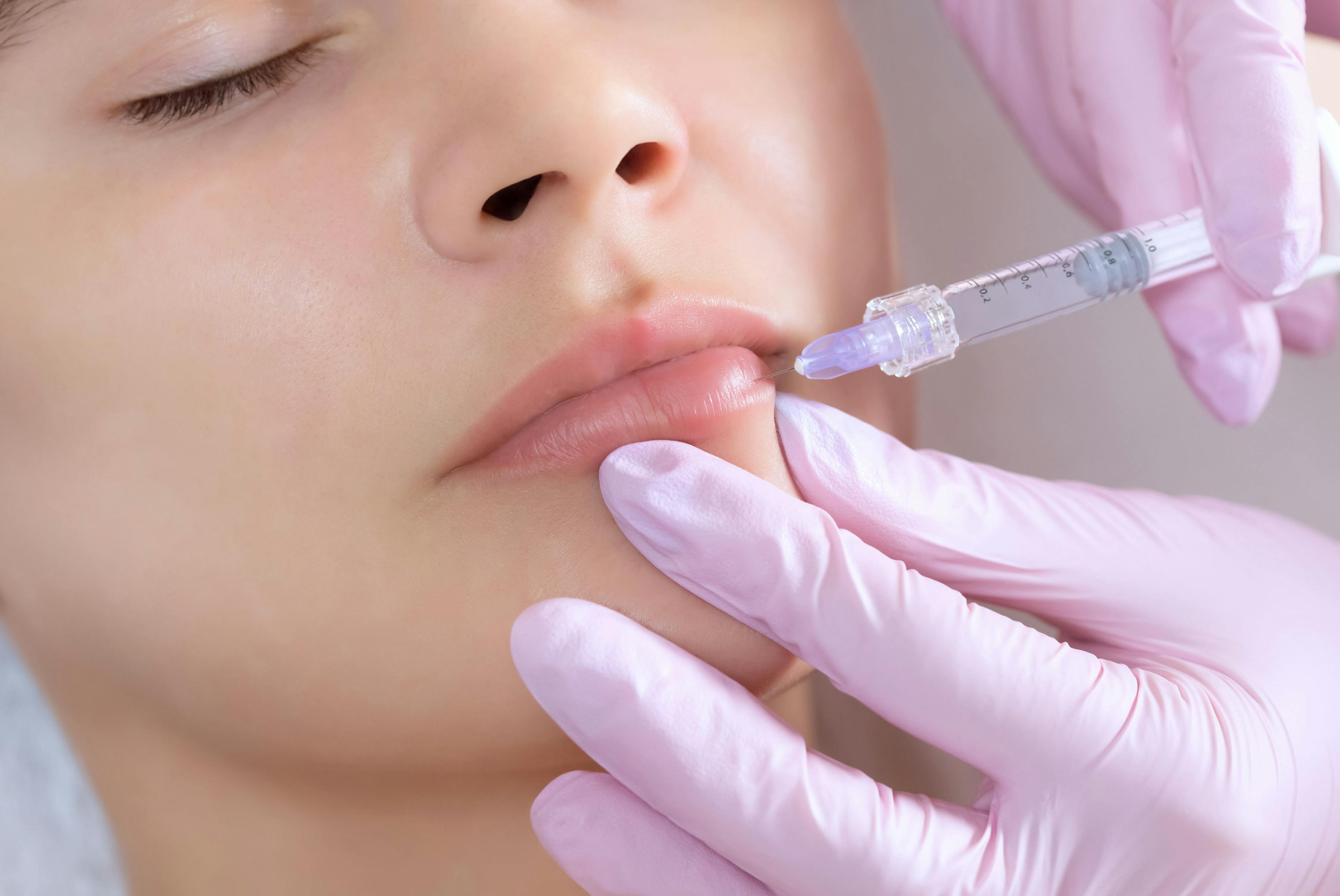 A surgical fix for problematic lip fillers