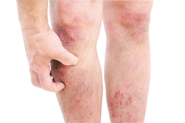Amlitelimab Demonstrates Sustained Improvements in Atopic Dermatitis Signs and Symptoms