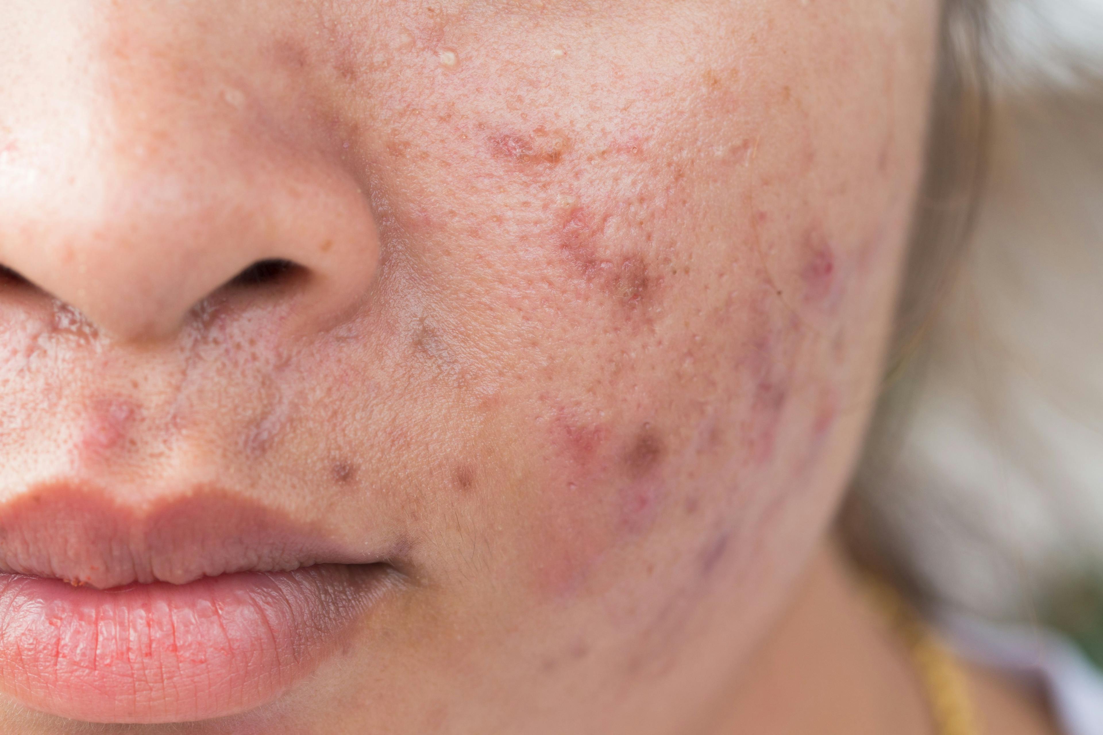 Minocycline as foam topical under study in acne