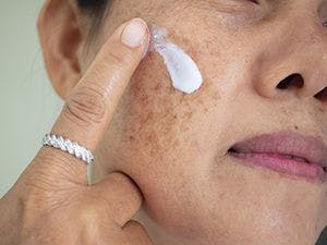 Sunscreen demonstrates strong therapeutic properties in patients with pigmentary disorders