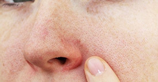 New Research Addresses Rosacea Challenges 