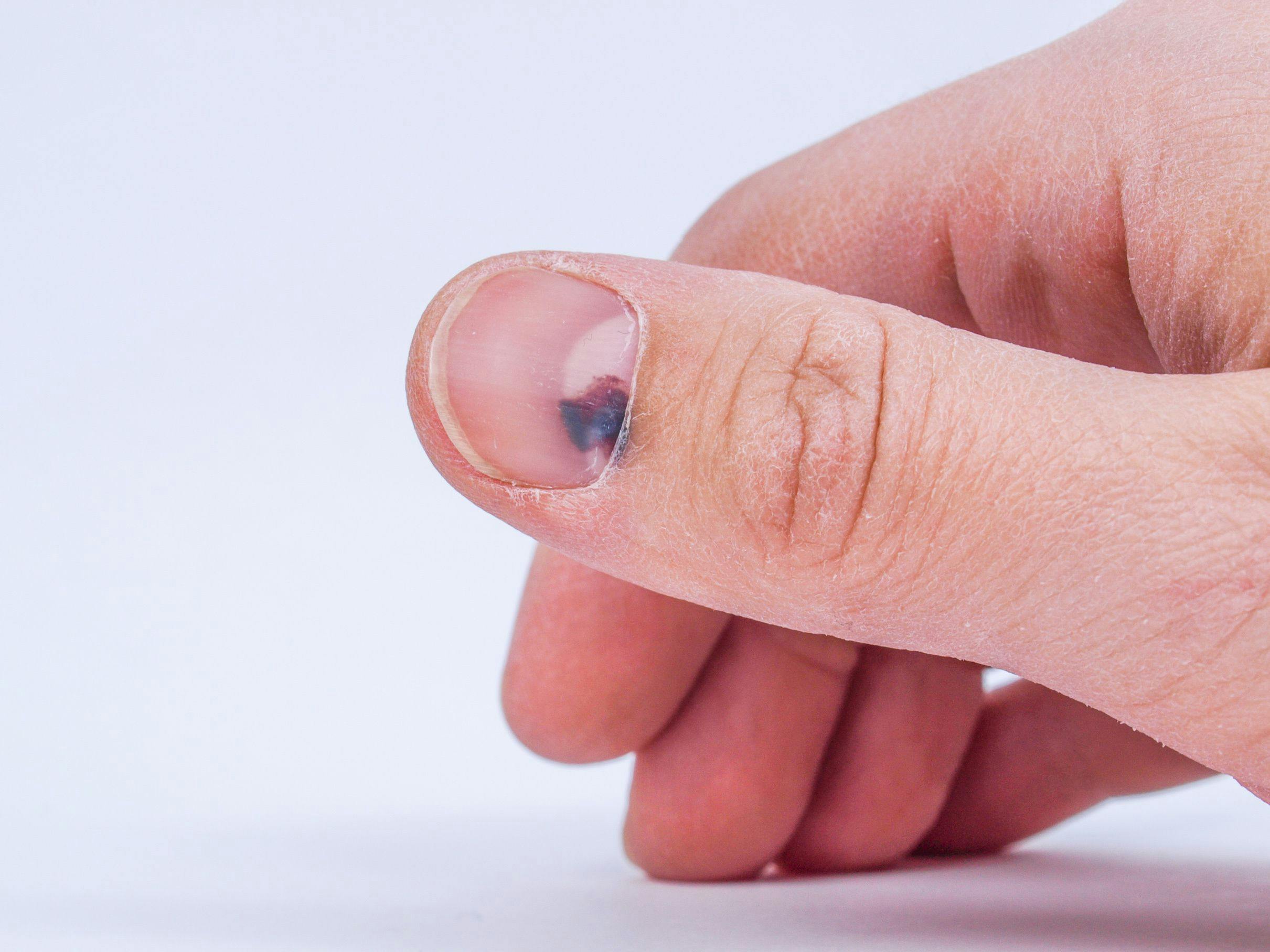 AAD Provides Nail Injury Treatment, Care Guidance