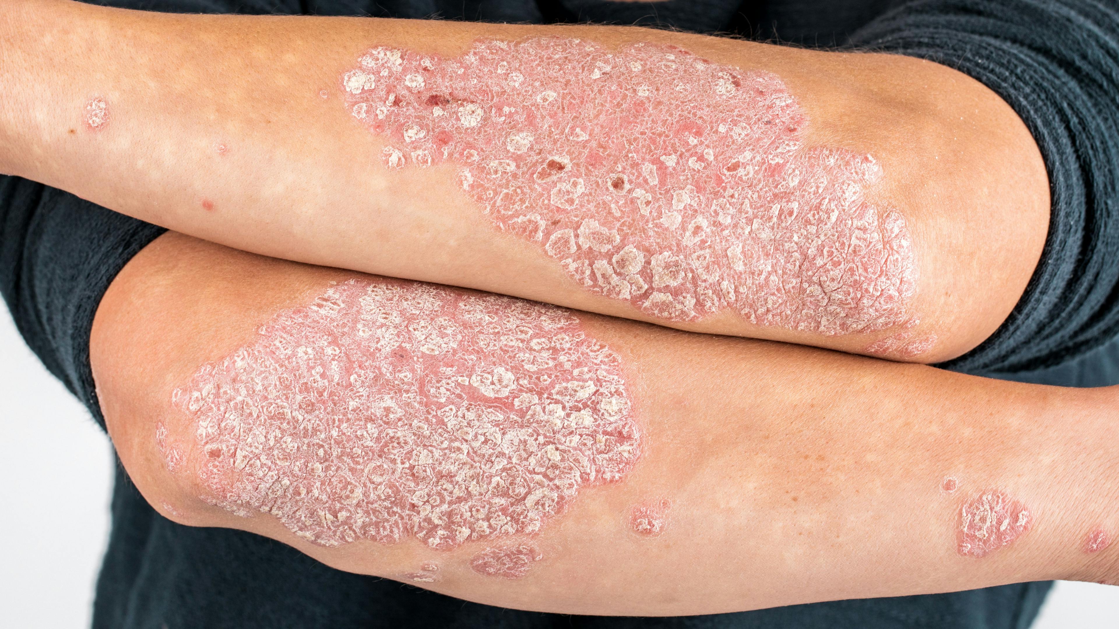 Study Finds Long-Term Safety and Efficacy for Roflumilast Cream for Chronic Plaque Psoriasis