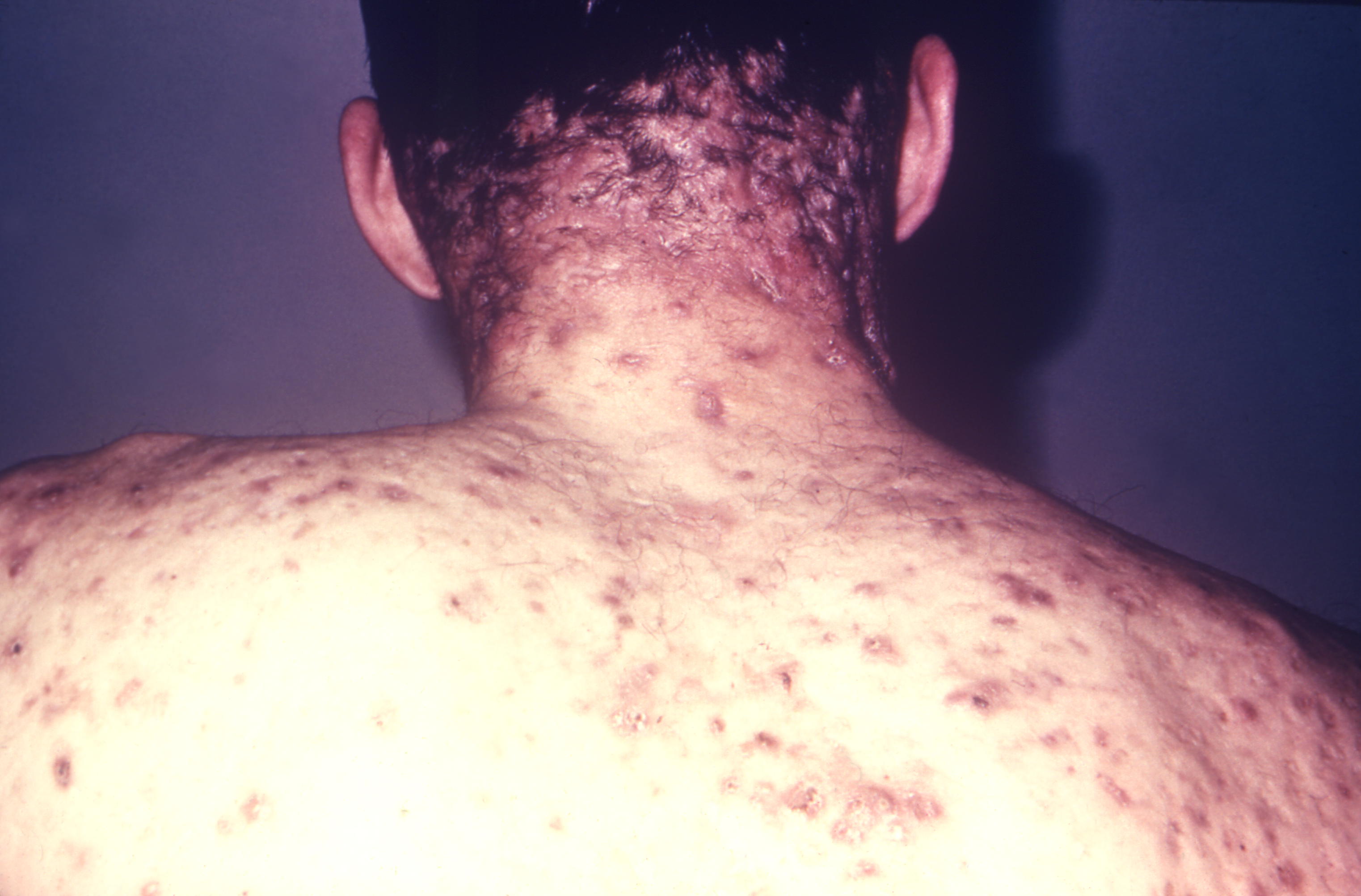 Acne Conglobata: An Overview and Effective Management Strategies 