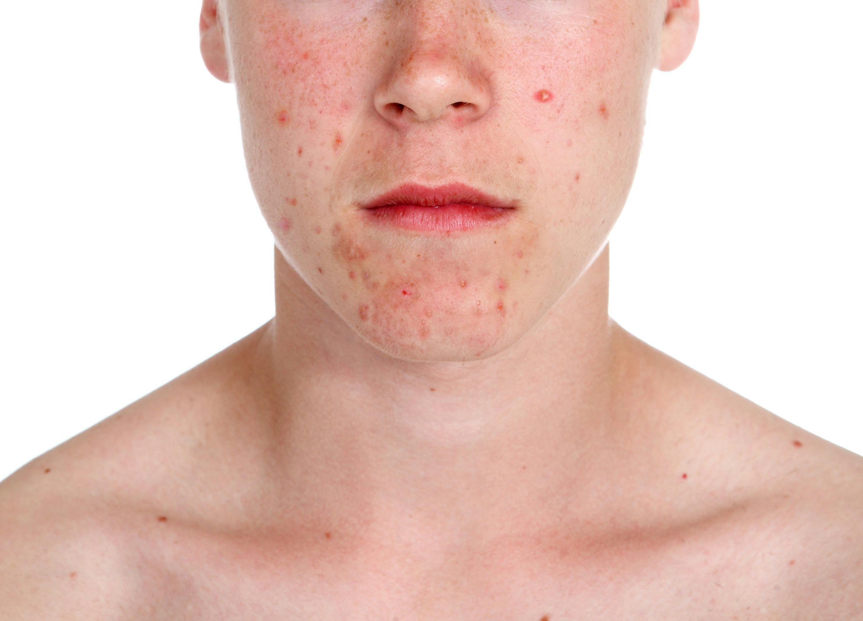The Role of Nonprescription Products in the Management of Acne