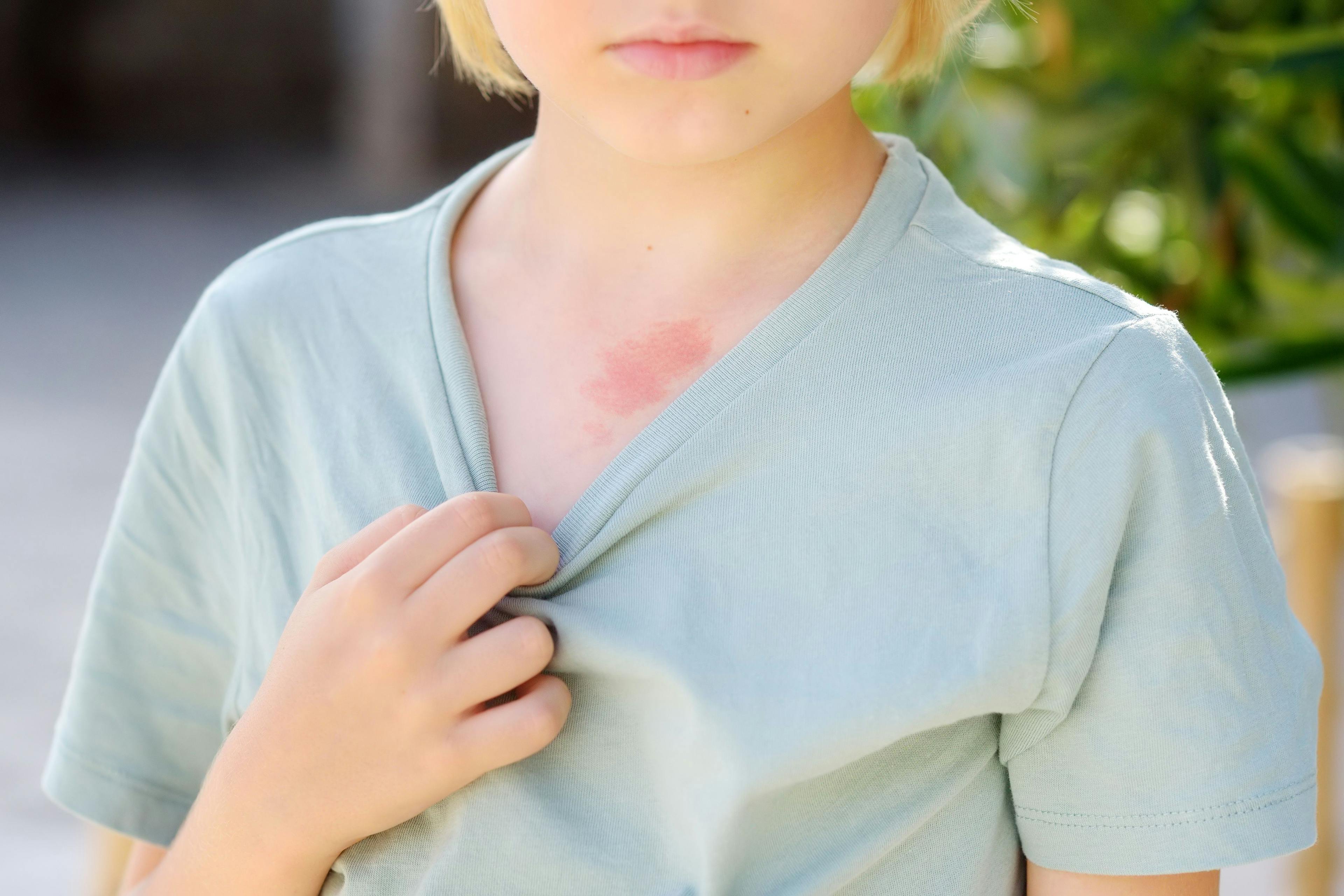 Young Patients With Dermatologic Conditions Face Increased Risk of Attachment Insecurity