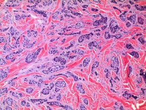 Black and Asian Patients With Apocrine Adenocarcinoma Demonstrate Significant Risk of Developing Secondary Primary Malignancies