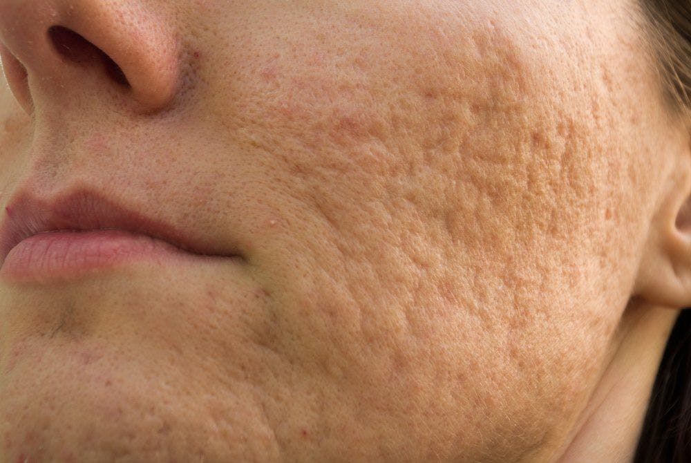 Topical treatment reduces scar formation in acne