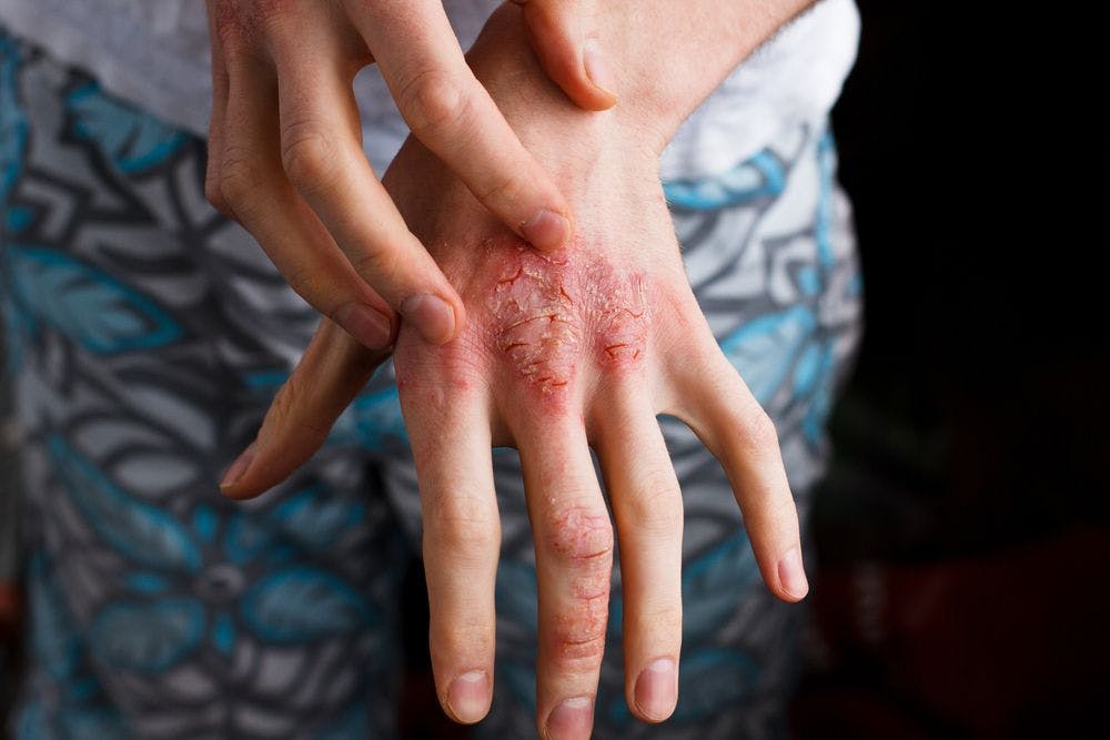person touching red, flaky skin on hand