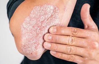 Expanding Line of Therapeutic Agents for Psoriasis 