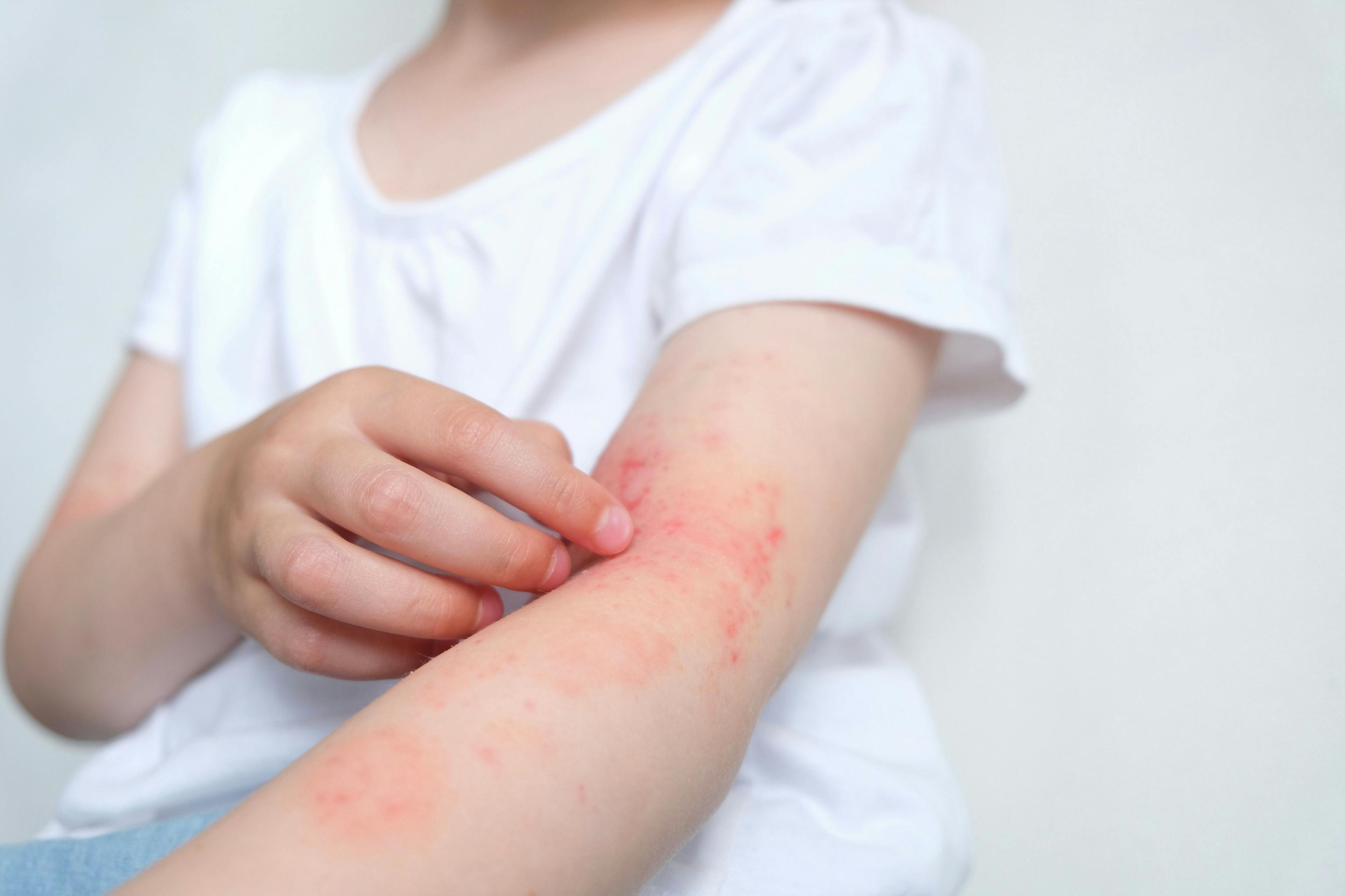 Study Explores if Atopic Dermatitis is Only a Skin Disease 