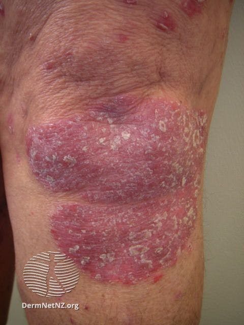 Chronic plaque psoriasis scales | Image credit: https://dermnetnz.org/images/chronic-plaque-psoriasis-images