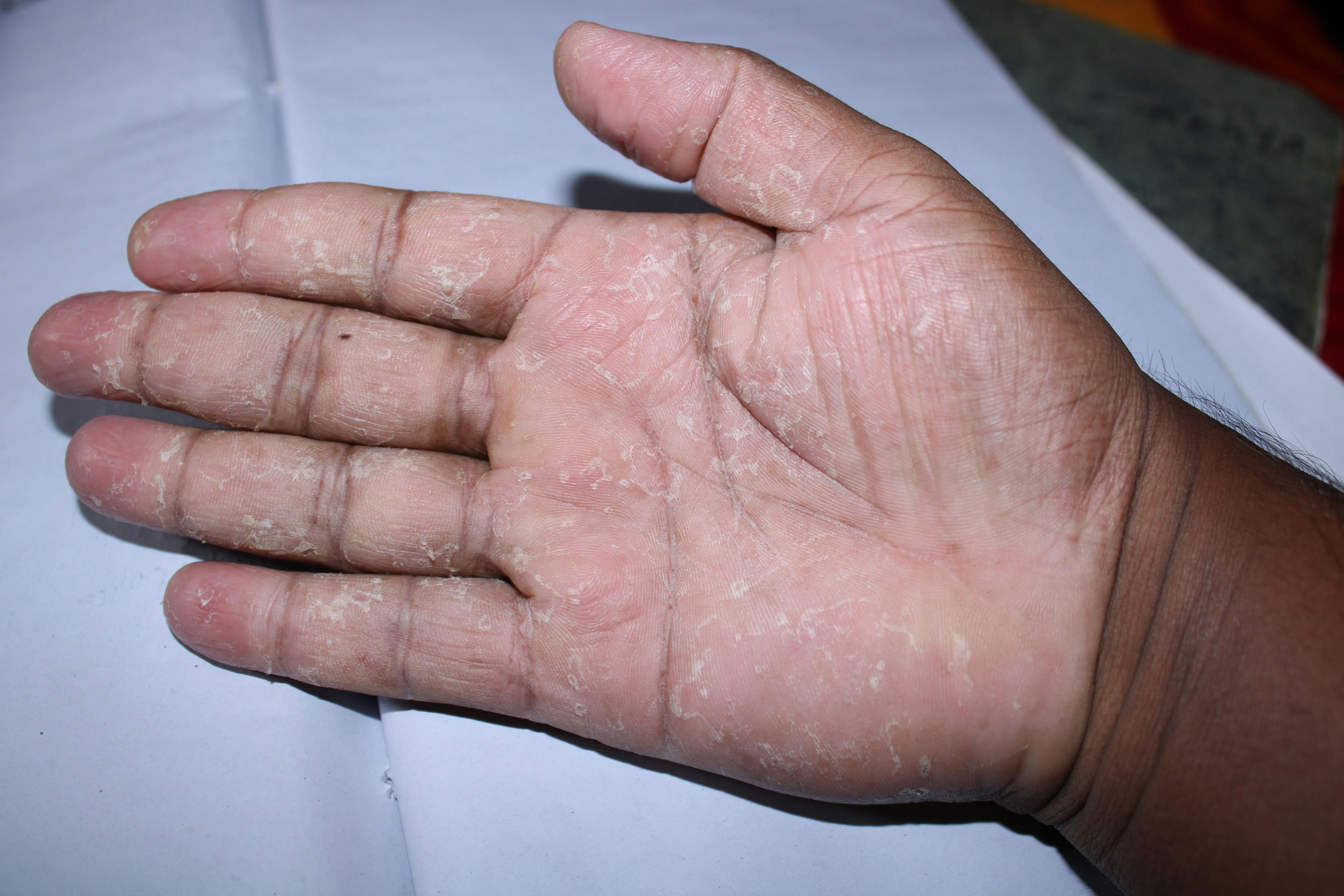 person of color with psoriasis on palm