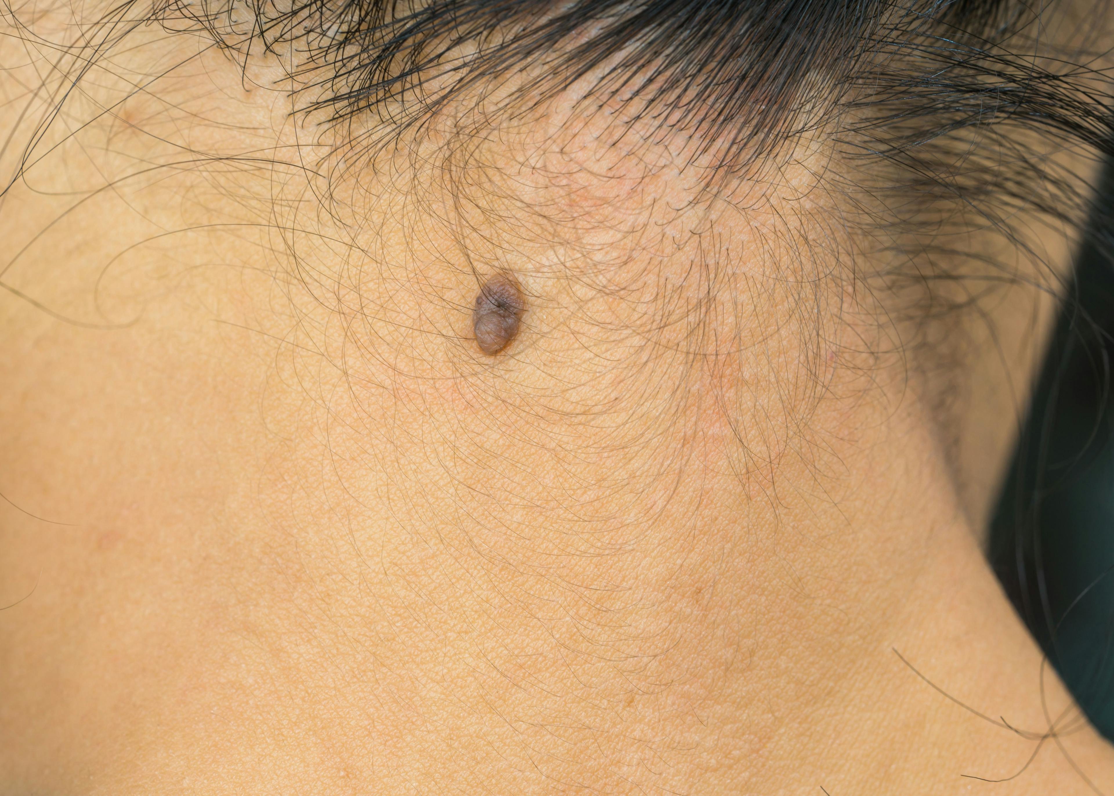 Black mole on the back of the neck of a woman