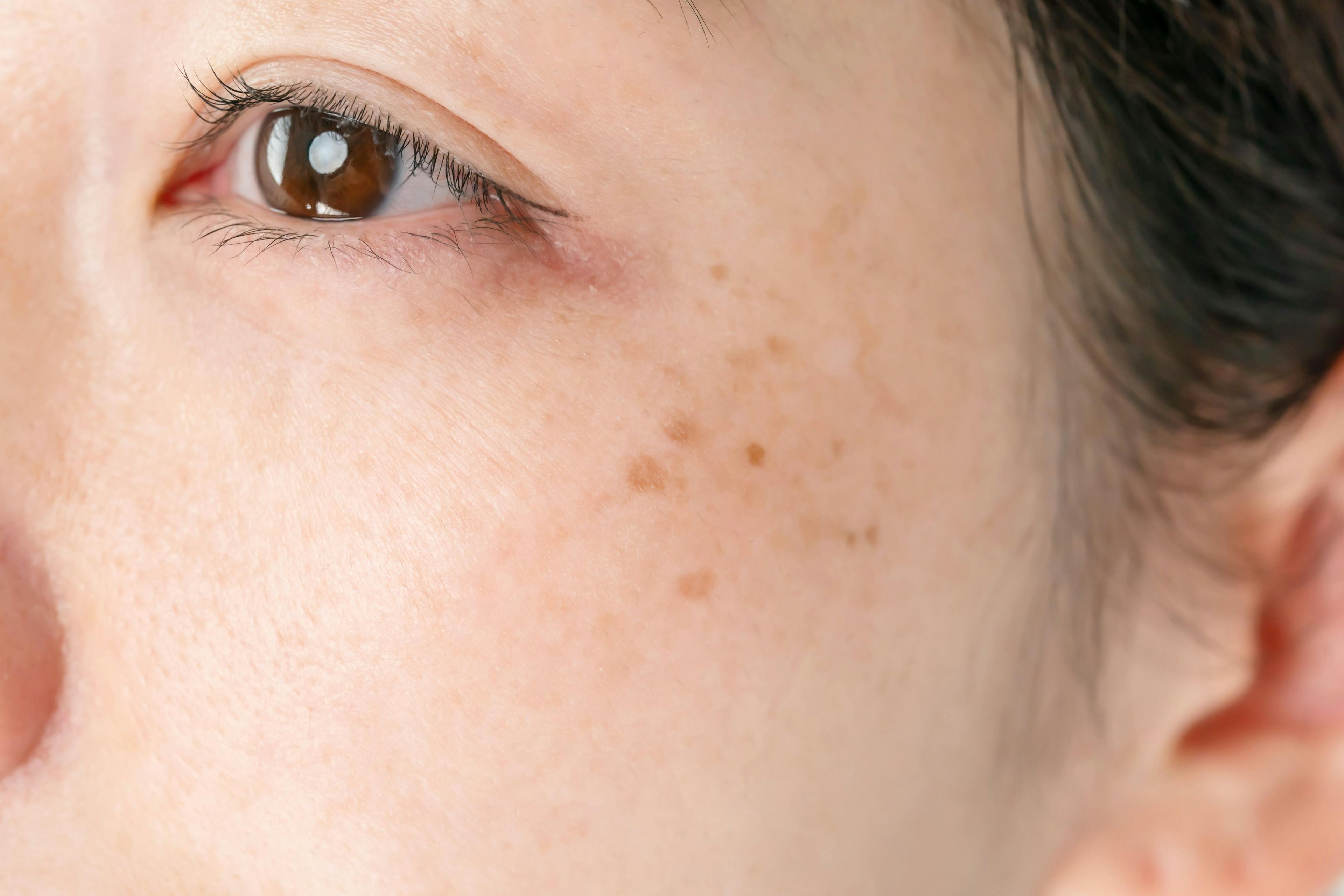 Reviewing Common and Prevalent Dermatoses in AAPI Patients