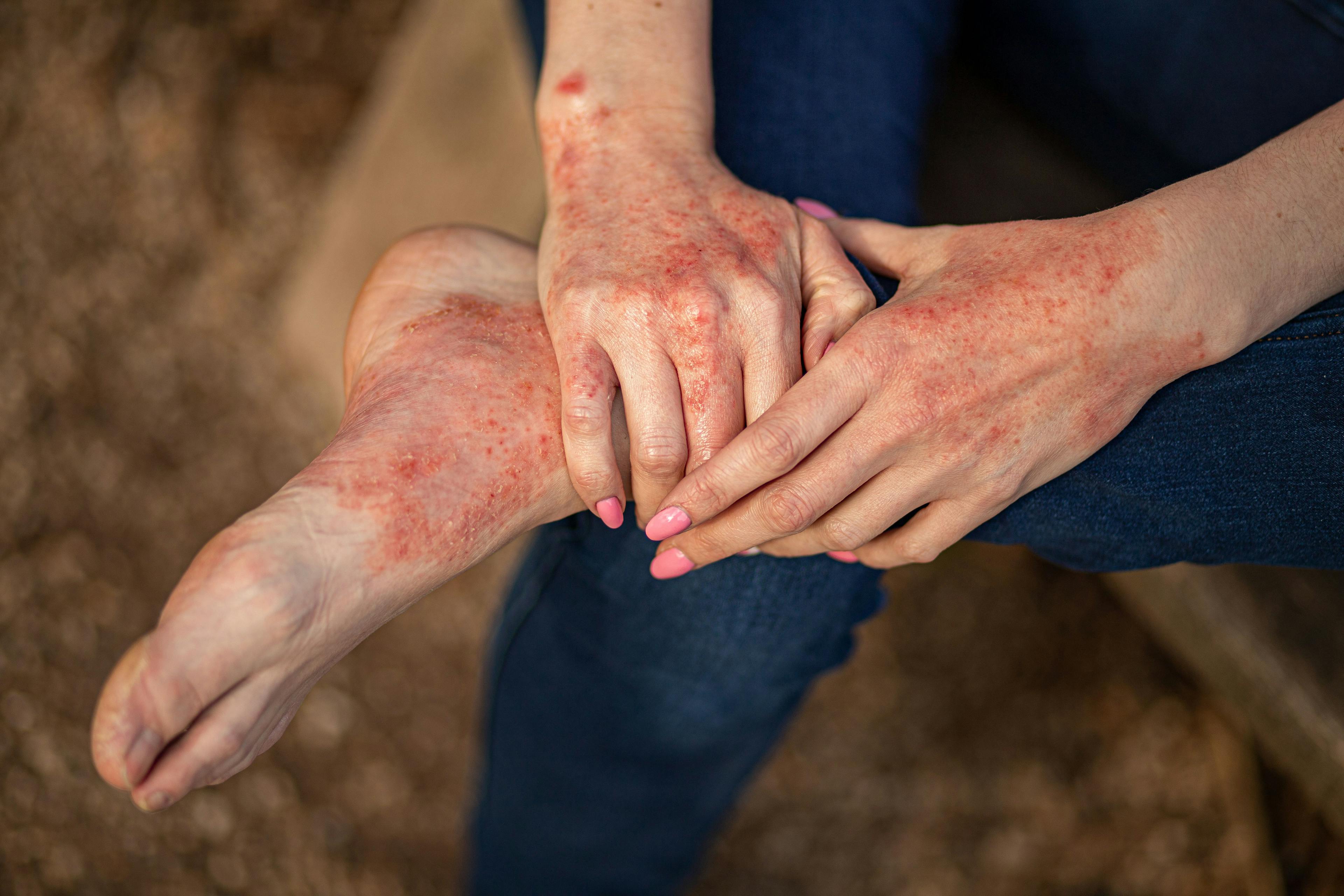 Efficacy of Dupilumab in Treating Atopic Hand and Foot Dermatitis 