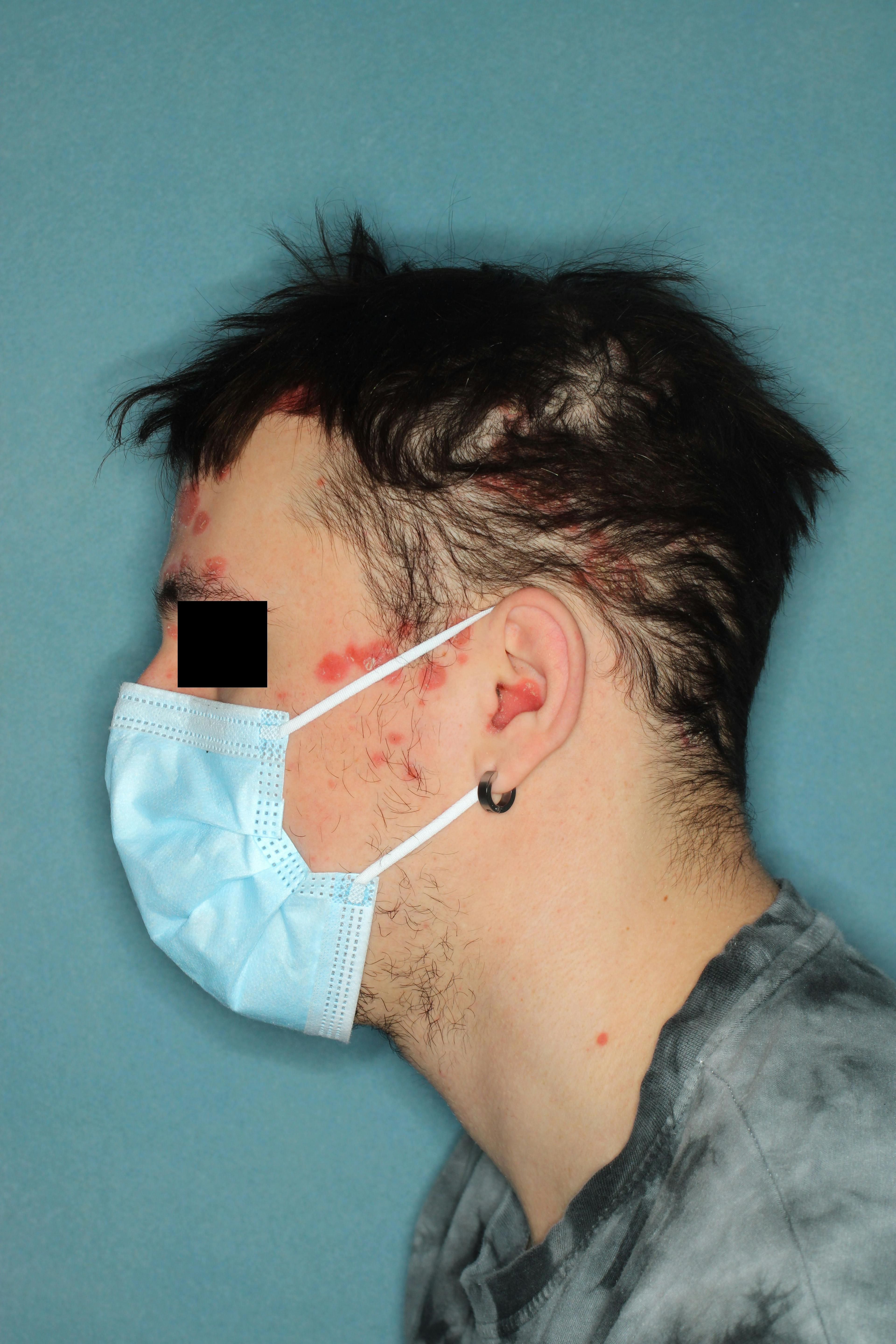 Patient with scalp psoriasis before treatment with guselkumab

Image courtesy of Johnson & Johnson 