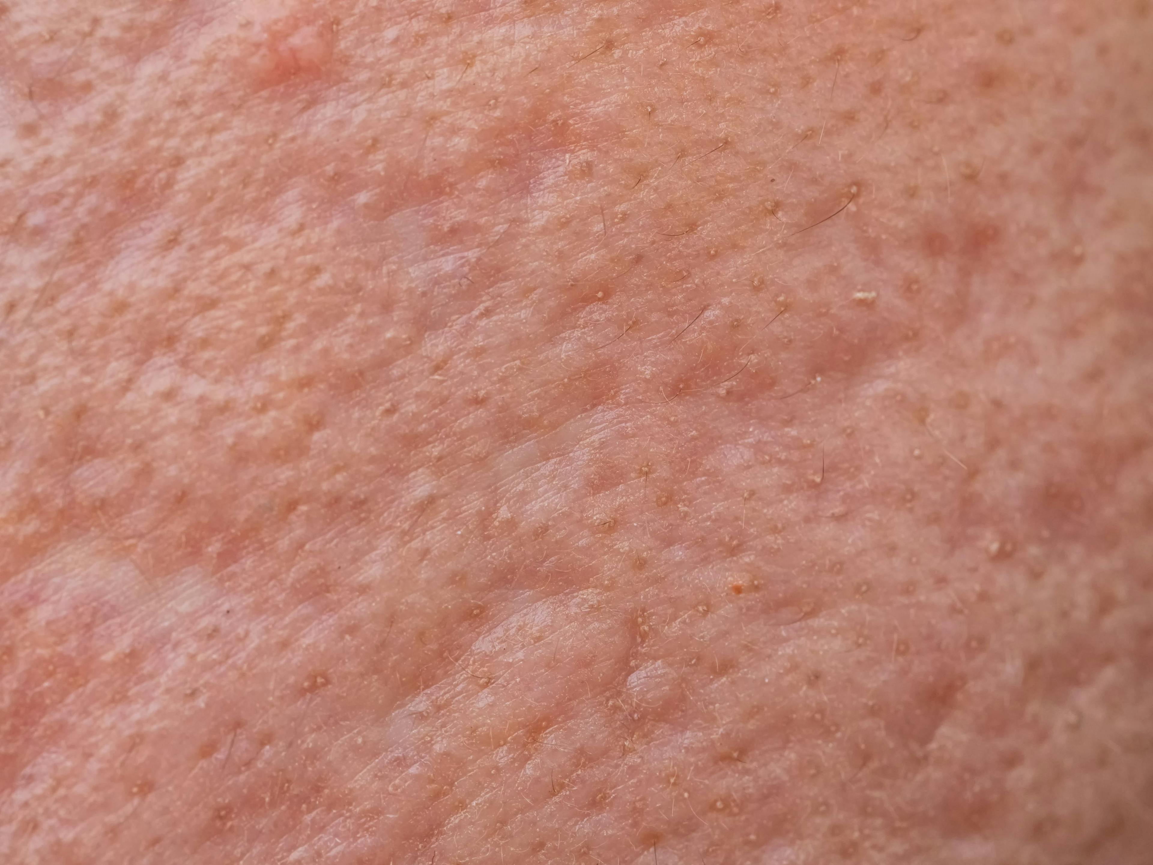 Patients rate acne scar subcision techniques