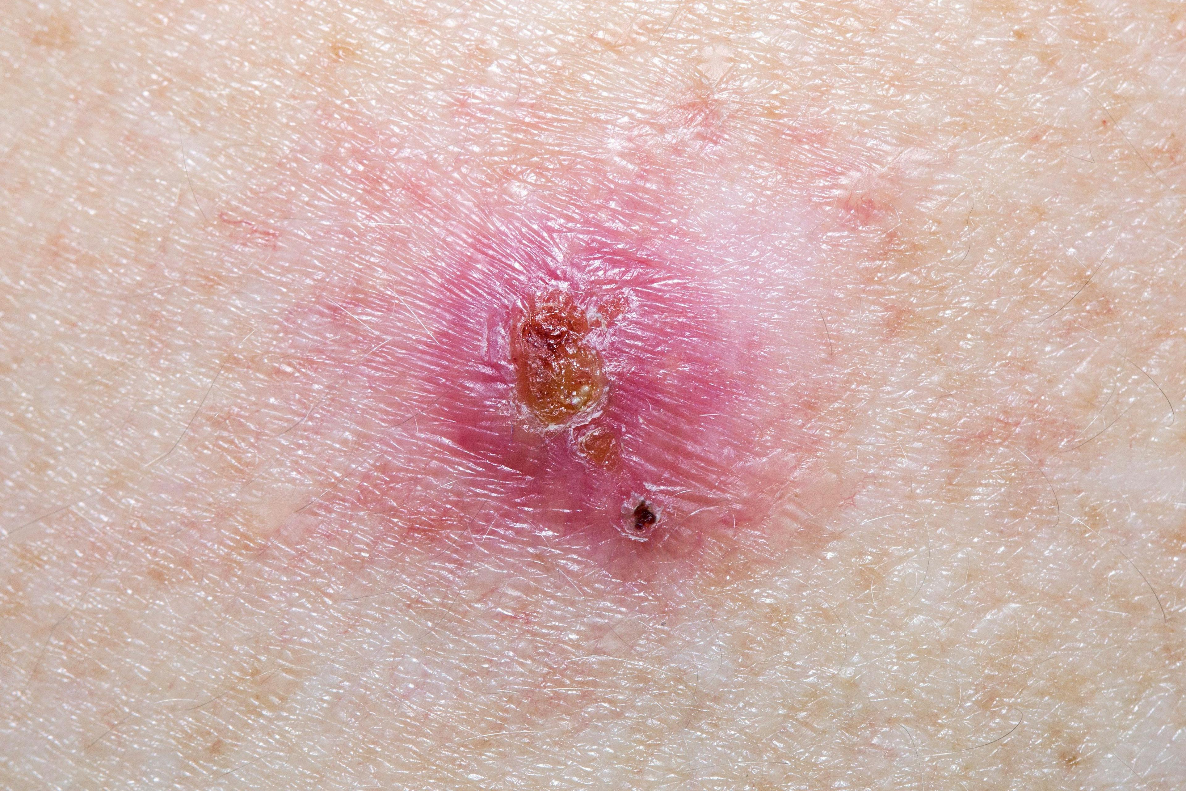 Hedgehog Inhibitor Therapy’s Use in Advanced Basal Cell Carcinoma – Does It Work?