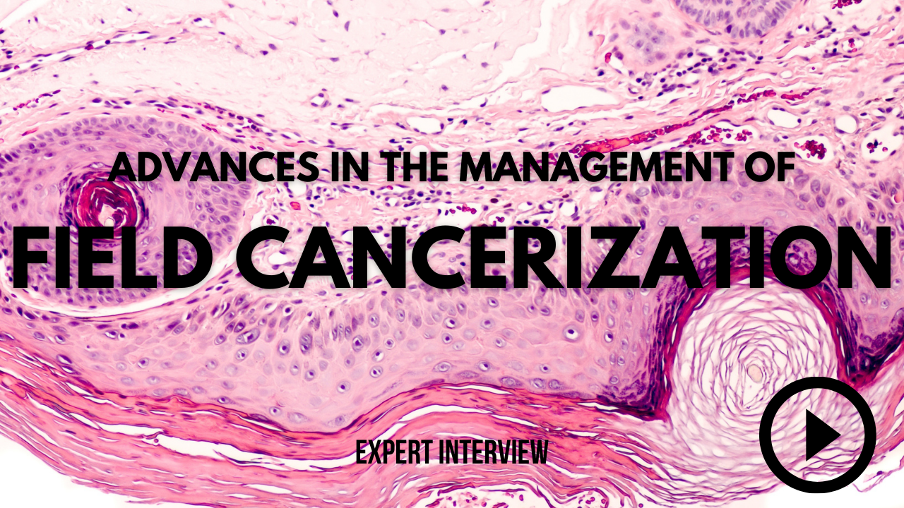  Advances in the Management of Field Cancerization