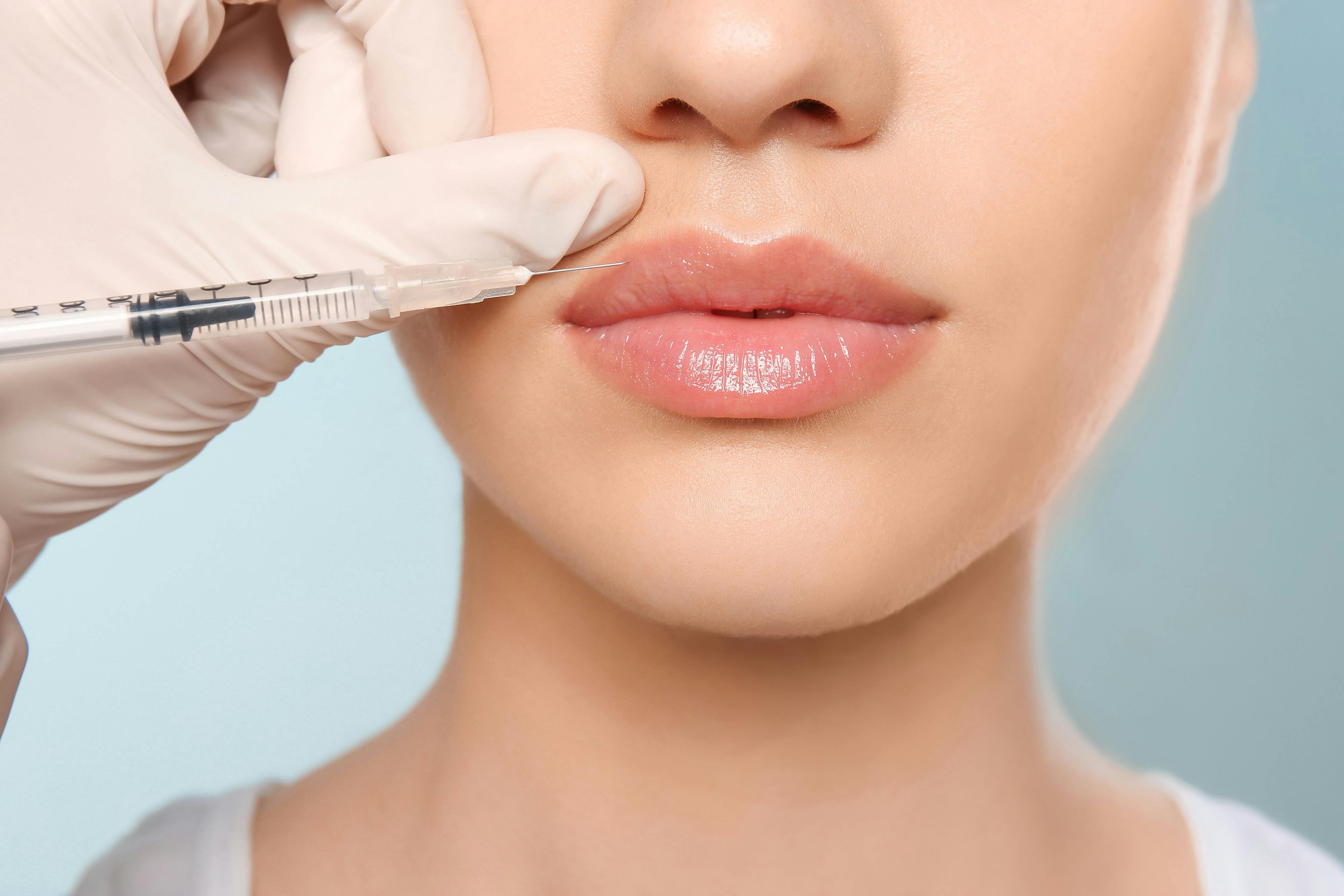 Botulinum Toxin A Effective in Upper Lip Enhancement 