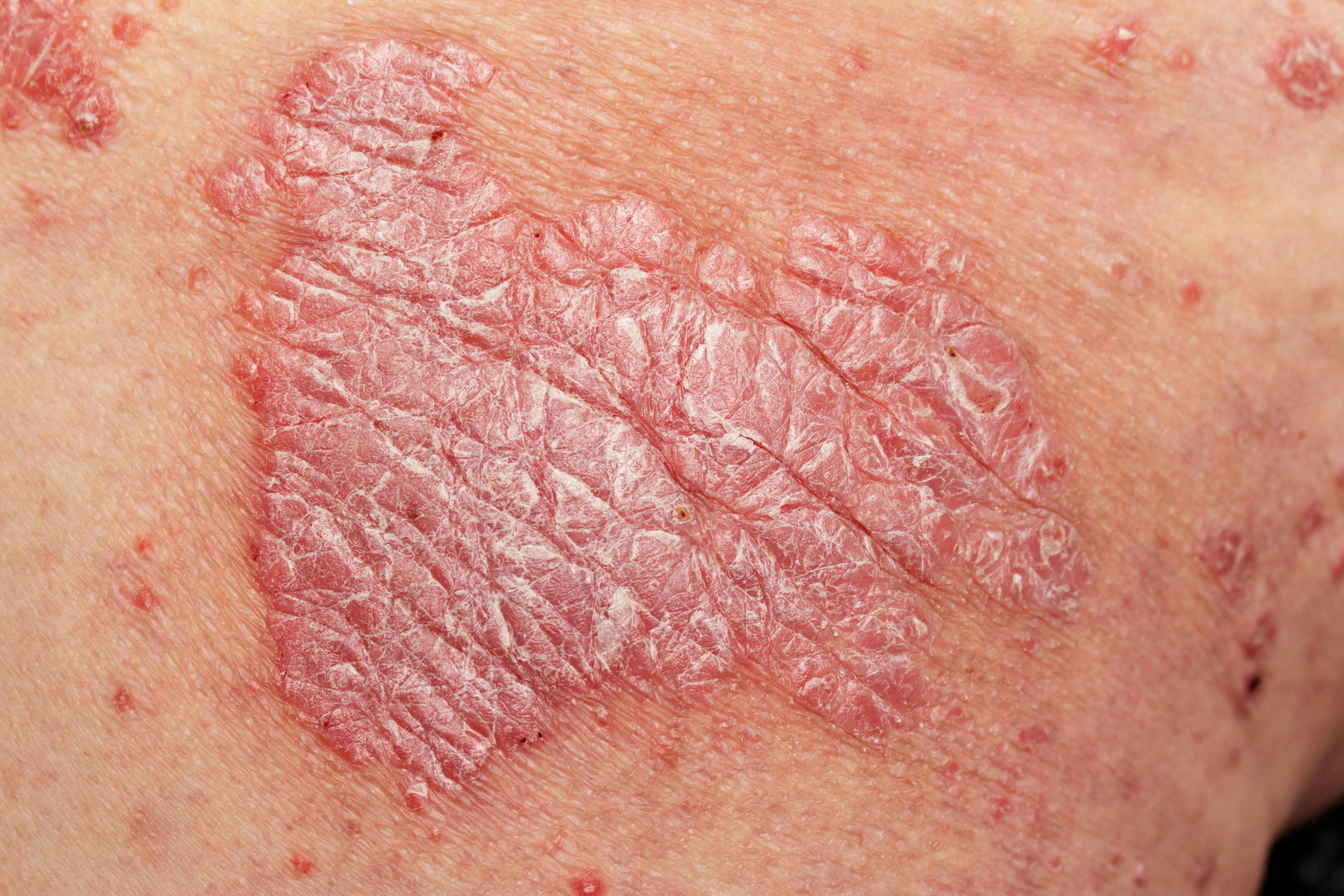 Psoriasis in Intertriginous Areas Has Negative Impact on Well-Being and Sexual Health  