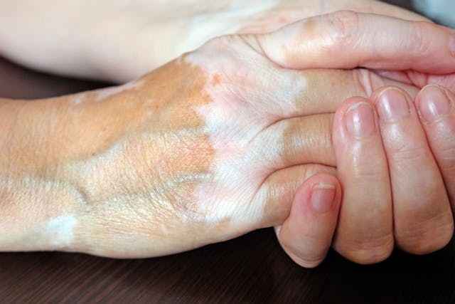 Reduced Incidence of Melanoma, Non-Melanoma Skin Cancers In Vitiligo