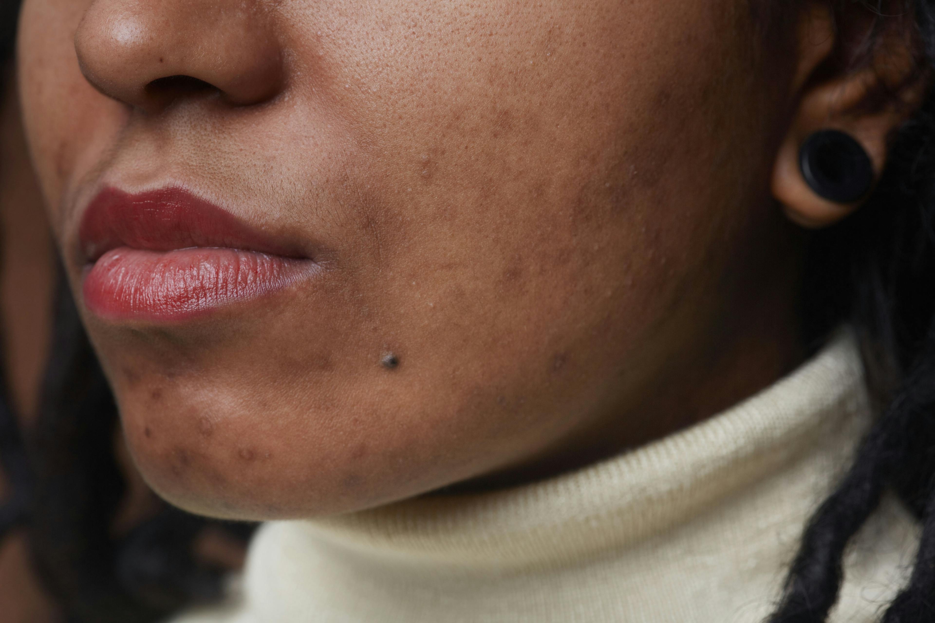 IDP-126 Gel Led to Improvements in Erythema Among Black Patients With Acne