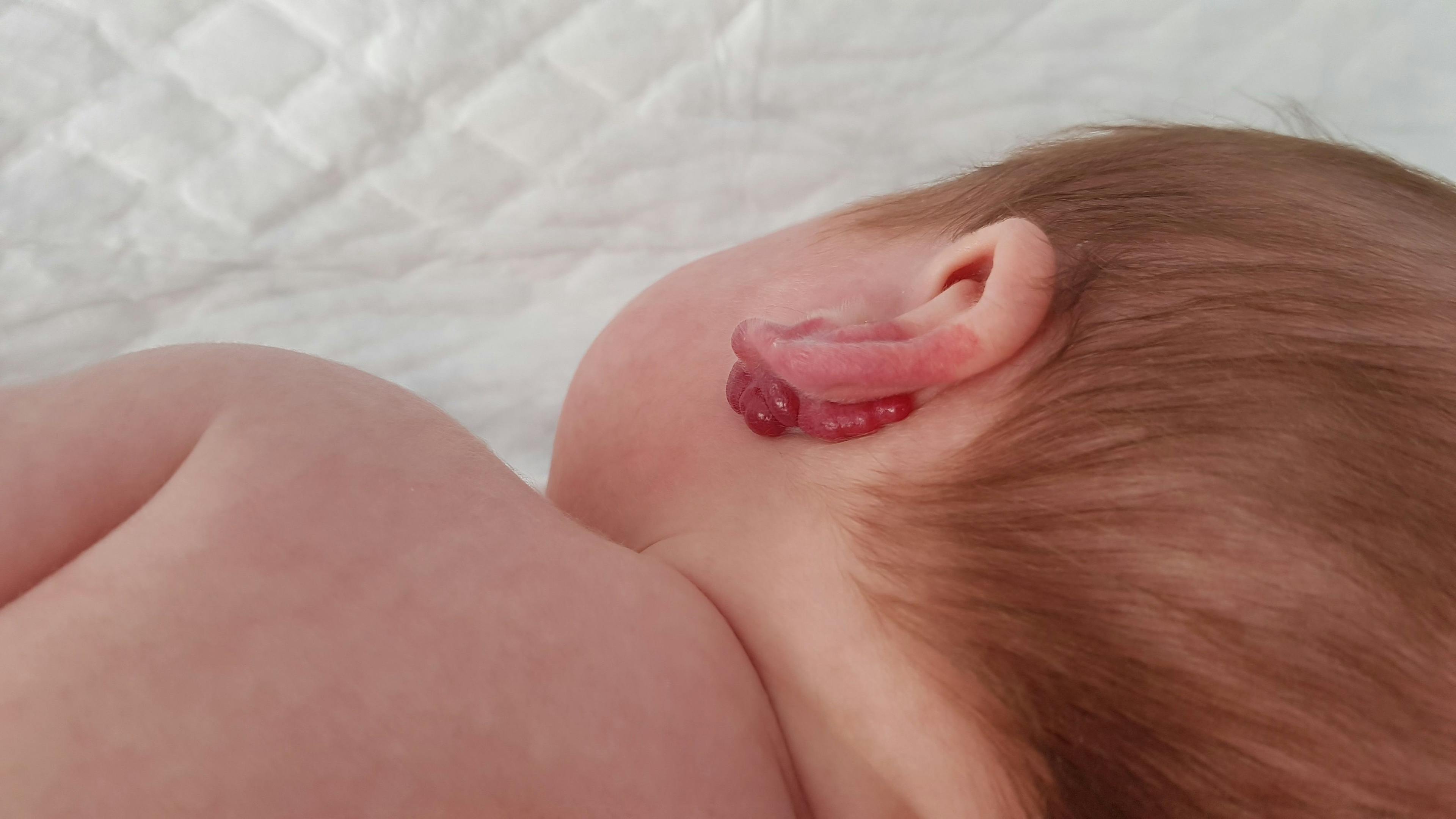 Severe Hemorrhage from Infantile Hemangioma
