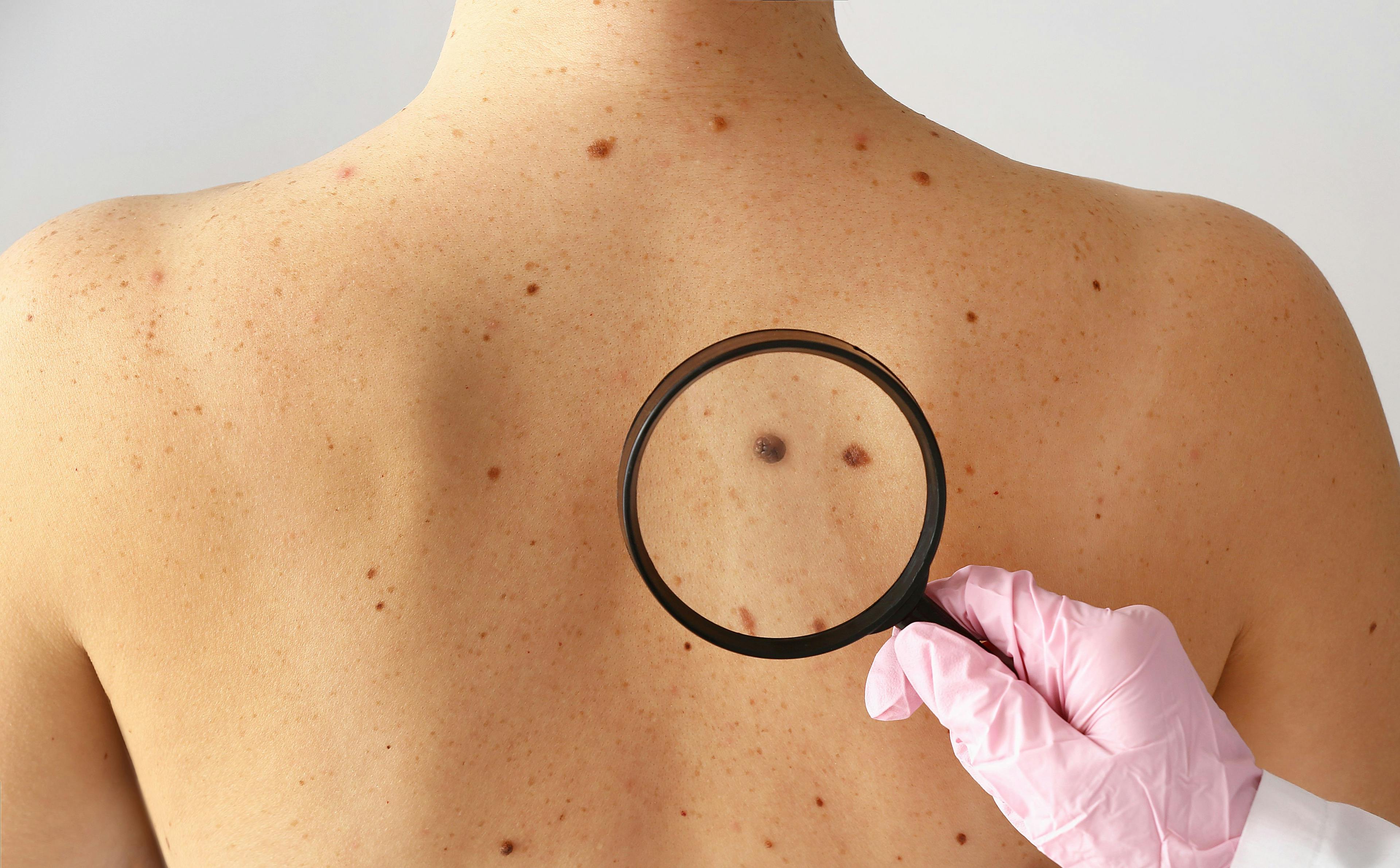 Early-Stage Melanoma Testing Technology Launched in the United States