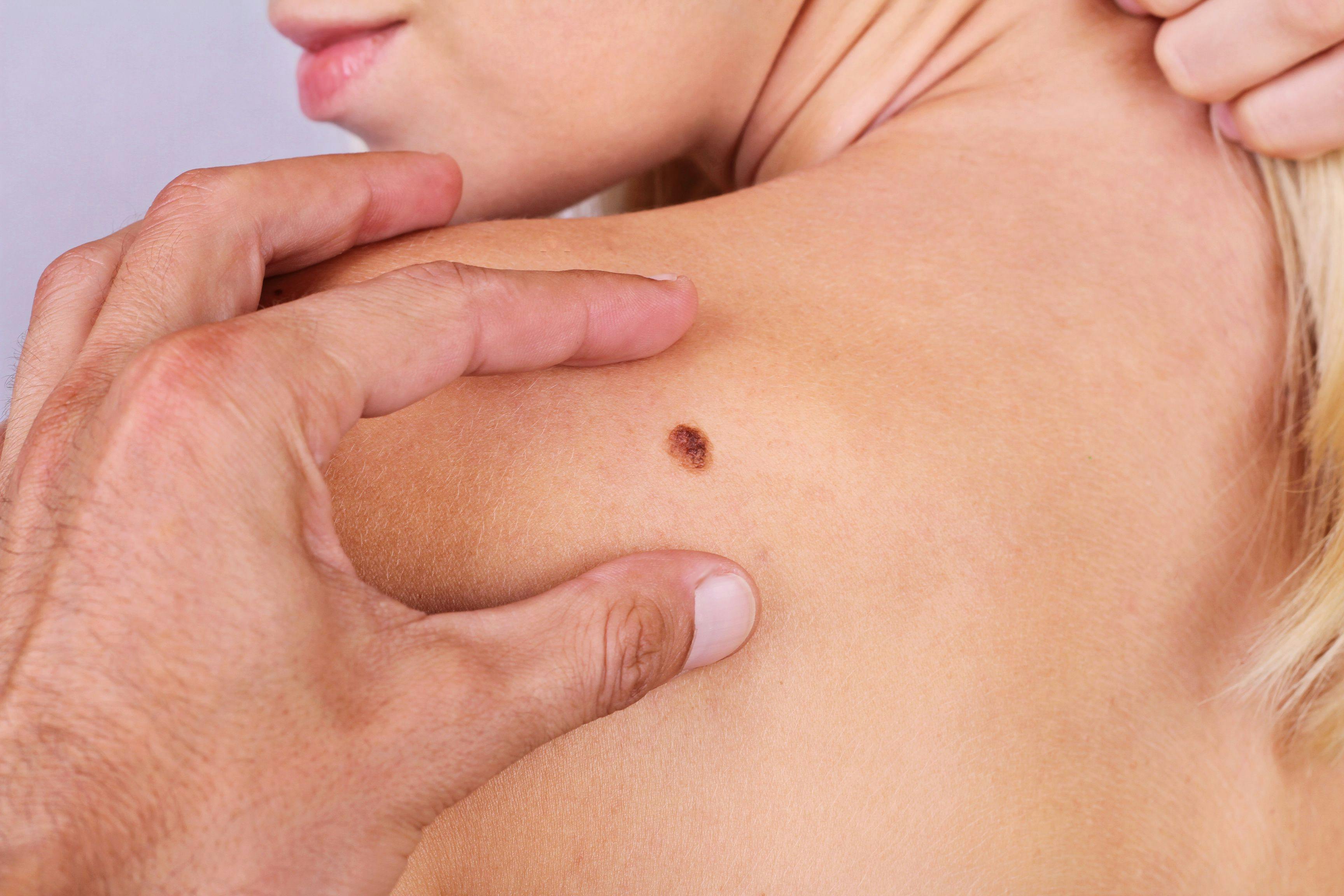 Available Treatment Options Helps Decrease Melanoma Mortality Rate 