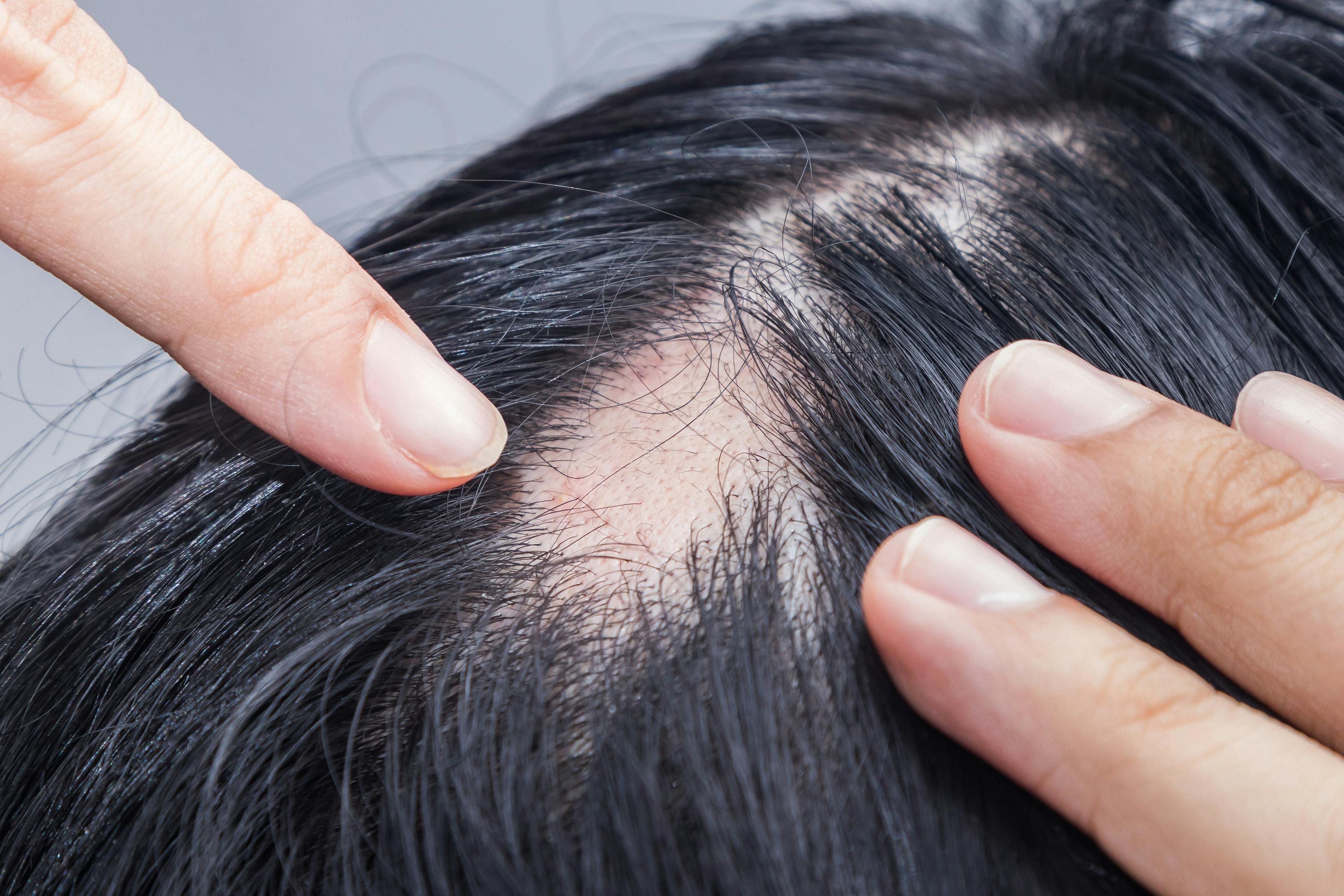 New Technology Could Allow Us to Rethink Alopecia Scores 
