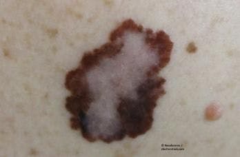 Long-term benefits of pembrolizumab in melanoma