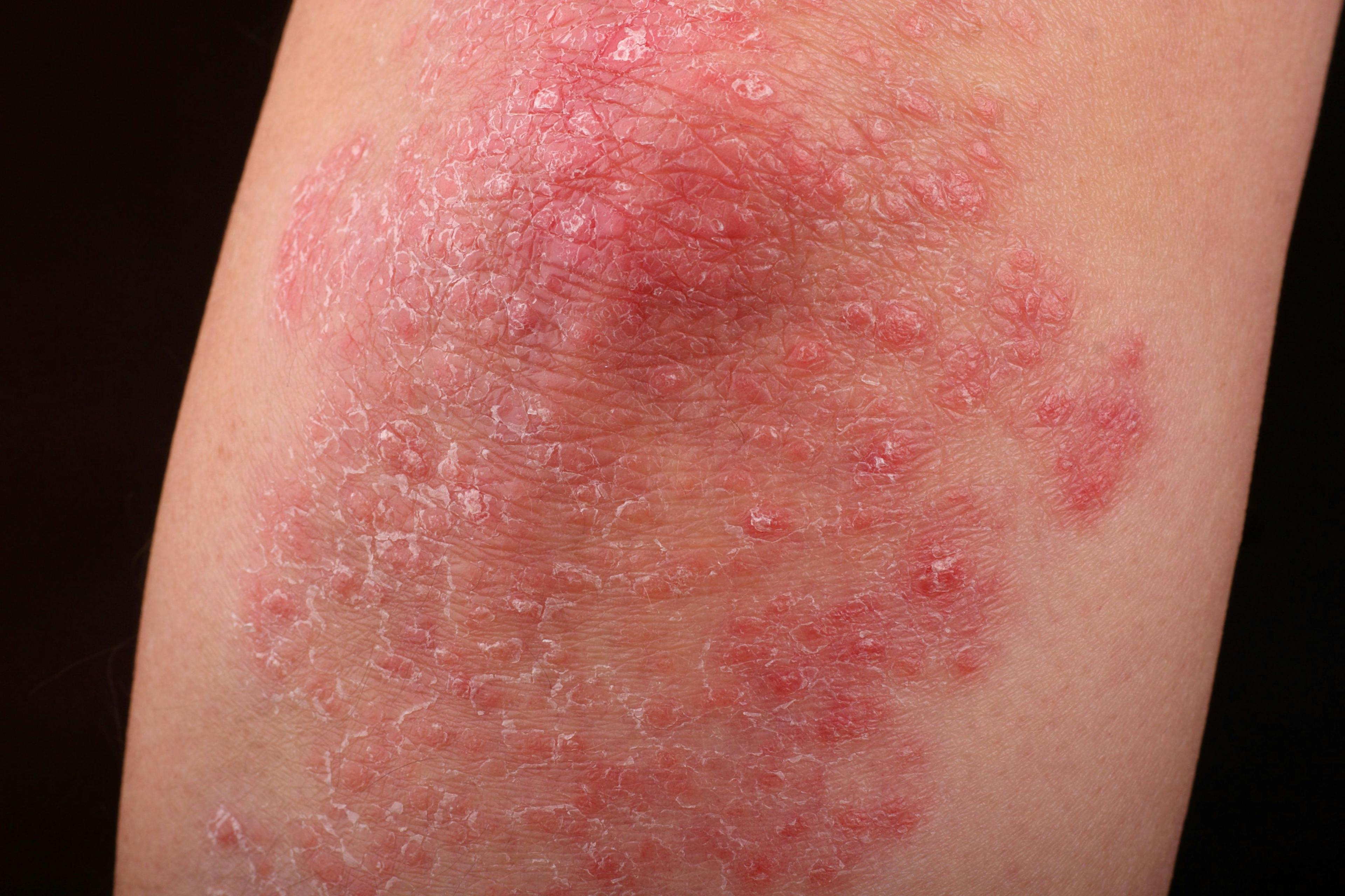 Solve the Challenges of Mild to Moderate Psoriasis 