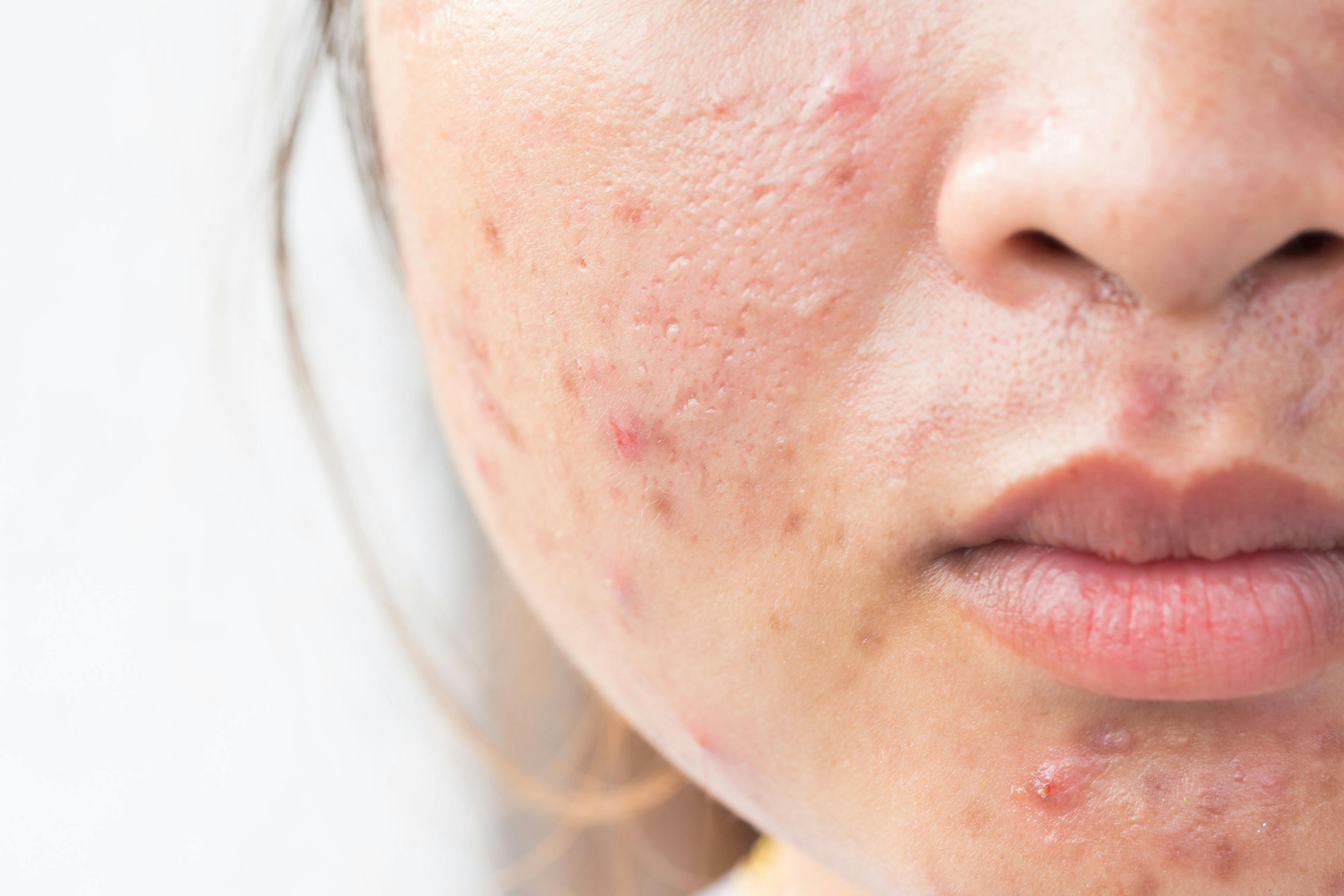IDP-126 Gel Shows Promising Results In Moderate-to-Severe Acne Treatment