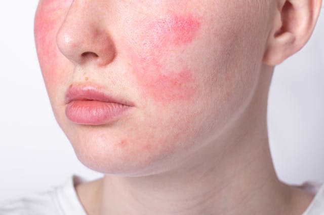 Mesoderm Therapy, Compound Glycyrrhizin Improves Rosacea and Patient Satisfaction