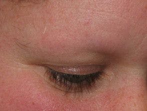 Higher Scalp Hair Loss Linked to Noticeable Gaps or Absence in Eyebrow and Eyelash Hair in Patient Study